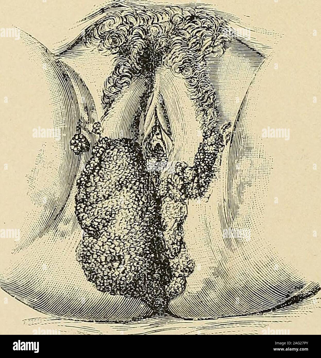 . The diagnosis and treatment of diseases of women. Fig. 258. Small Masses of Condylomata.Gynecology.) (Gi a,irL—Practical. Stock Photo