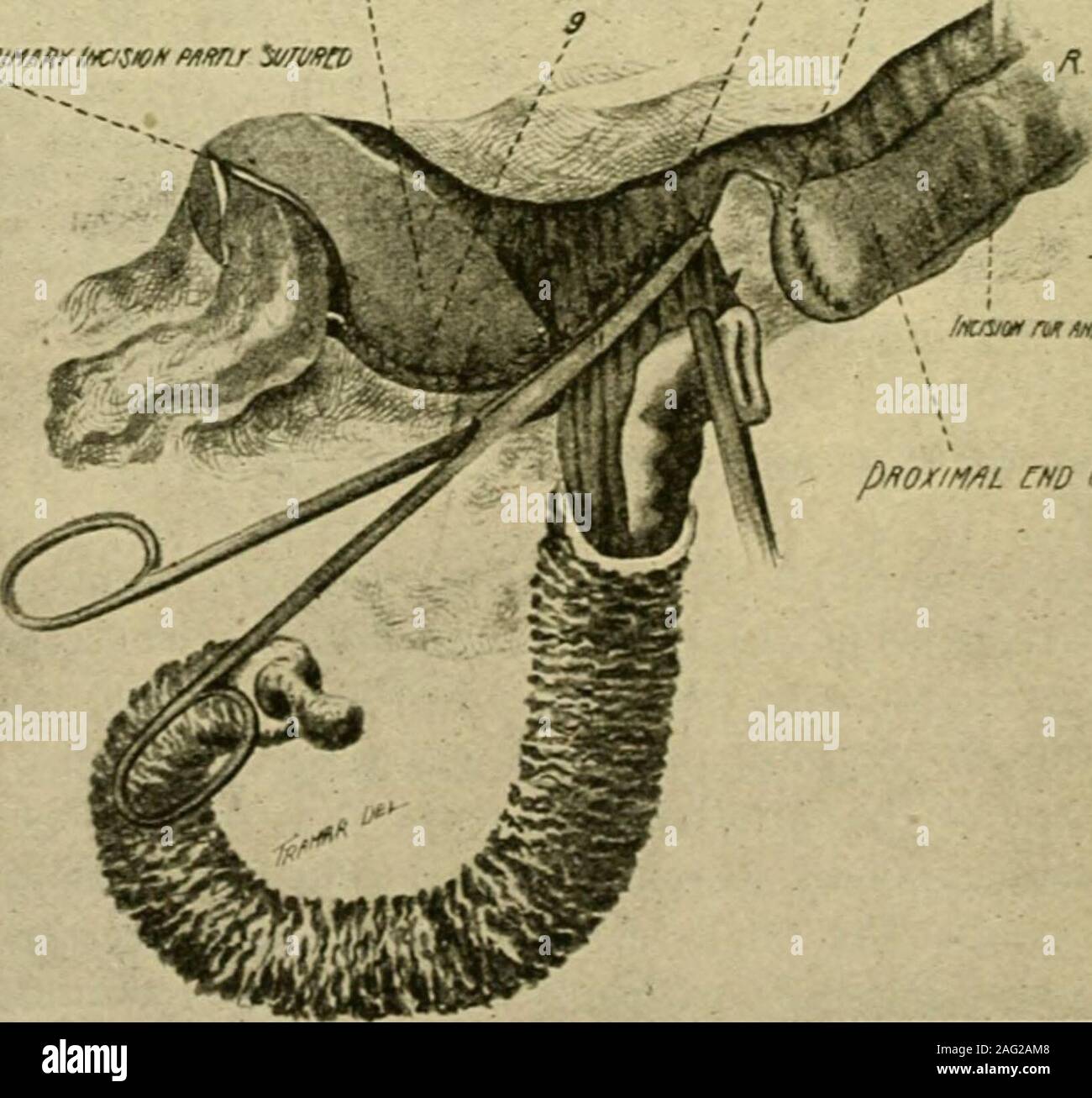 . Manual of operative surgery. Fig. 607. 2. Intussusception withdrawn ...