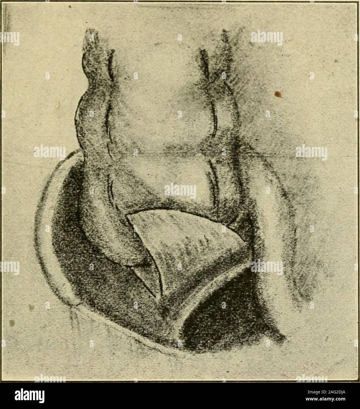 . Manual of operative surgery. he stitches in the widergut are inserted more widely apart than in the narrower gut then a secure unionis easily obtained. The cut edges of the ileal and colonic mesenteries must be carefully united by suturing both the upper and lower aspects of their junction. Lane finds the end-to-end anastomosis preferable in every respect to the lateral or end-to-side. In the treatment of intestinal stasis Lane considers colectomy the opera- C^COPEXY 437 tion of choice. He also prefers it to any partial operation in obstruction dueto mobile colonic tumors and in megalo-colon Stock Photo