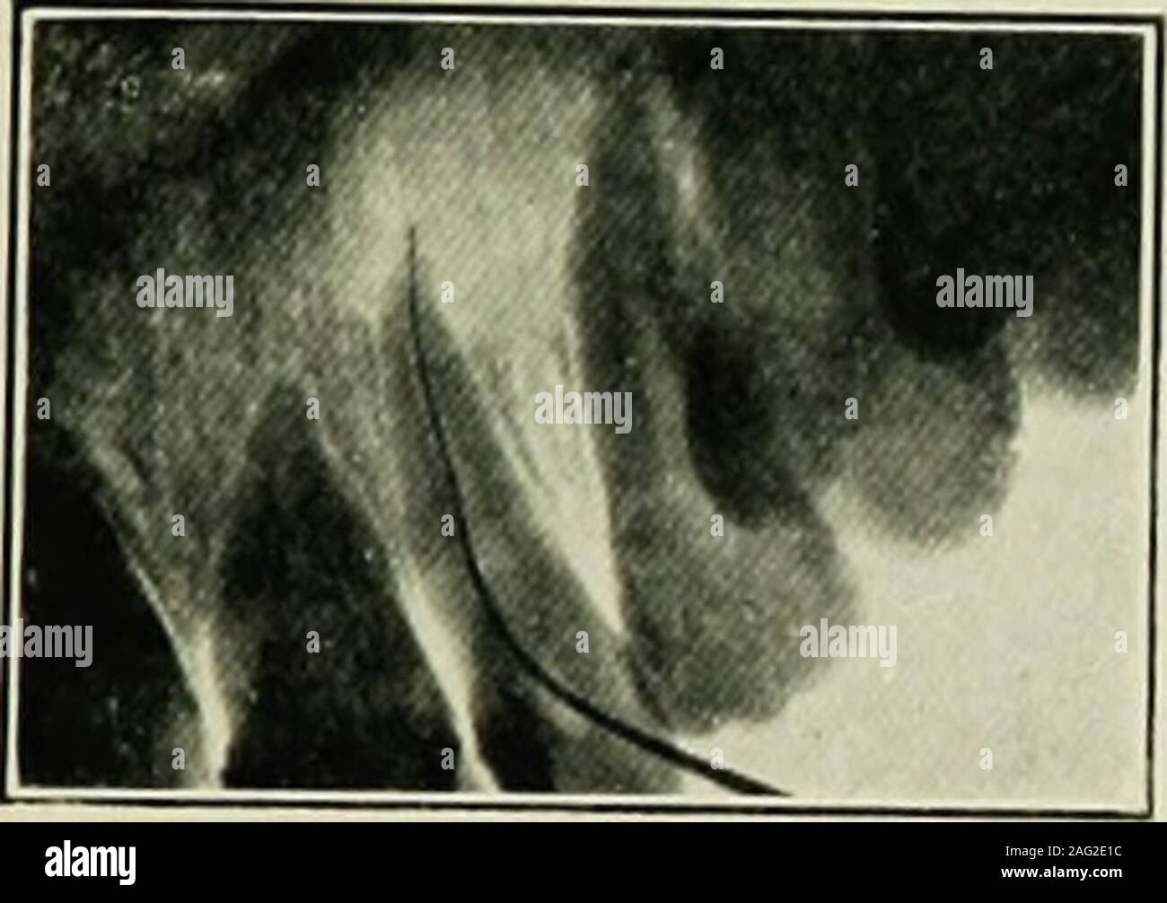 . Dental electrotherapeutics. Abscess on lower molar showing ex