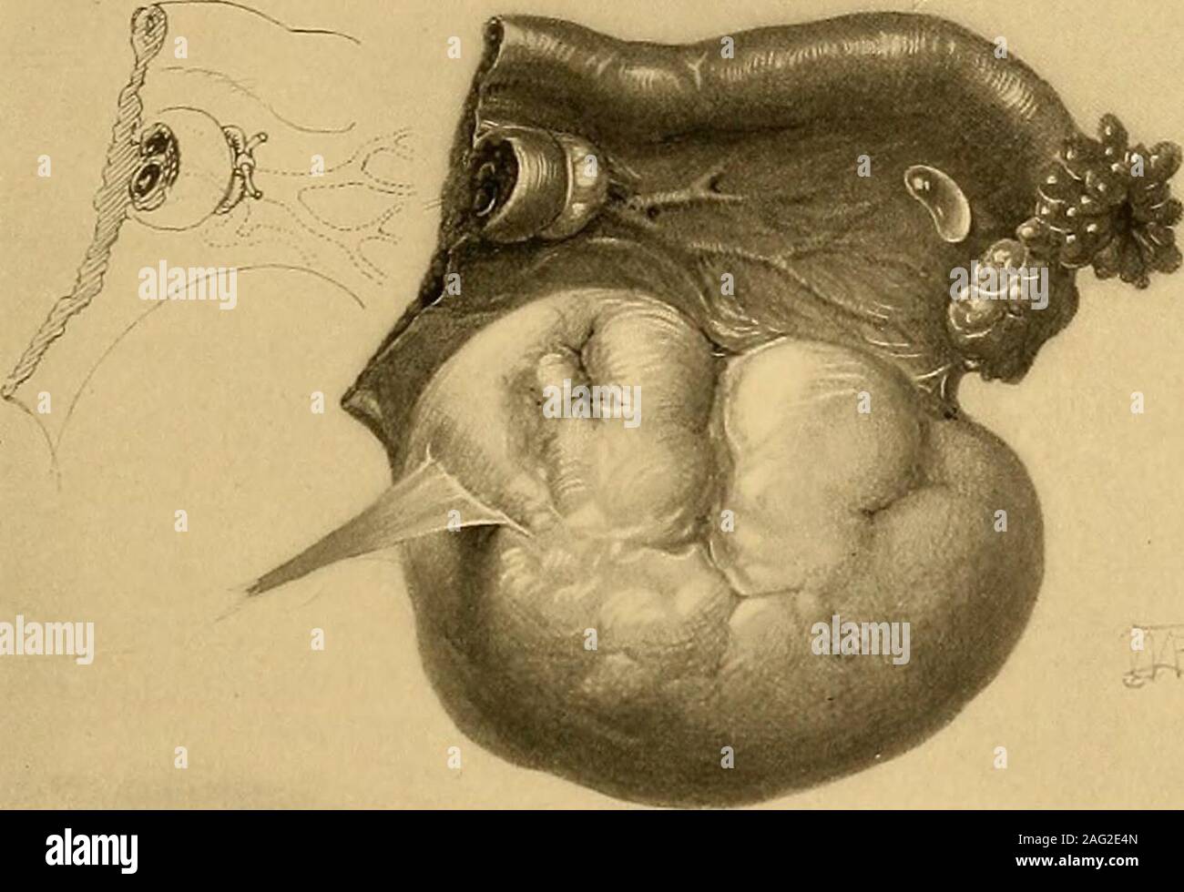 . Operative gynecology. es forward. By transfixing with the needle, aashown, and tying over the top of the broad ligament in the direction of the dotted line, all the ovarian ves-sels are secured. LIGATION OF THE PEDICLE. 25 ovarian aud uterine vessels separately, leaving the membranous interval free, andvithout attempting to draw them together. When the structures are removedthis leaves two little hunches of tissue holding the vessels, one at the pelvicbrim under the cecum or under the sigmoid flexure, aud the other at the uterinecornu; between these the peritoneal layers of the broad ligame Stock Photo
