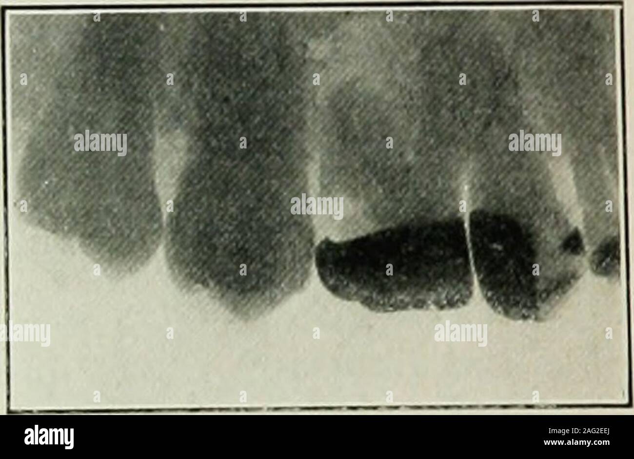 . Dental electrotherapeutics. Fig. 107 represents the left upper