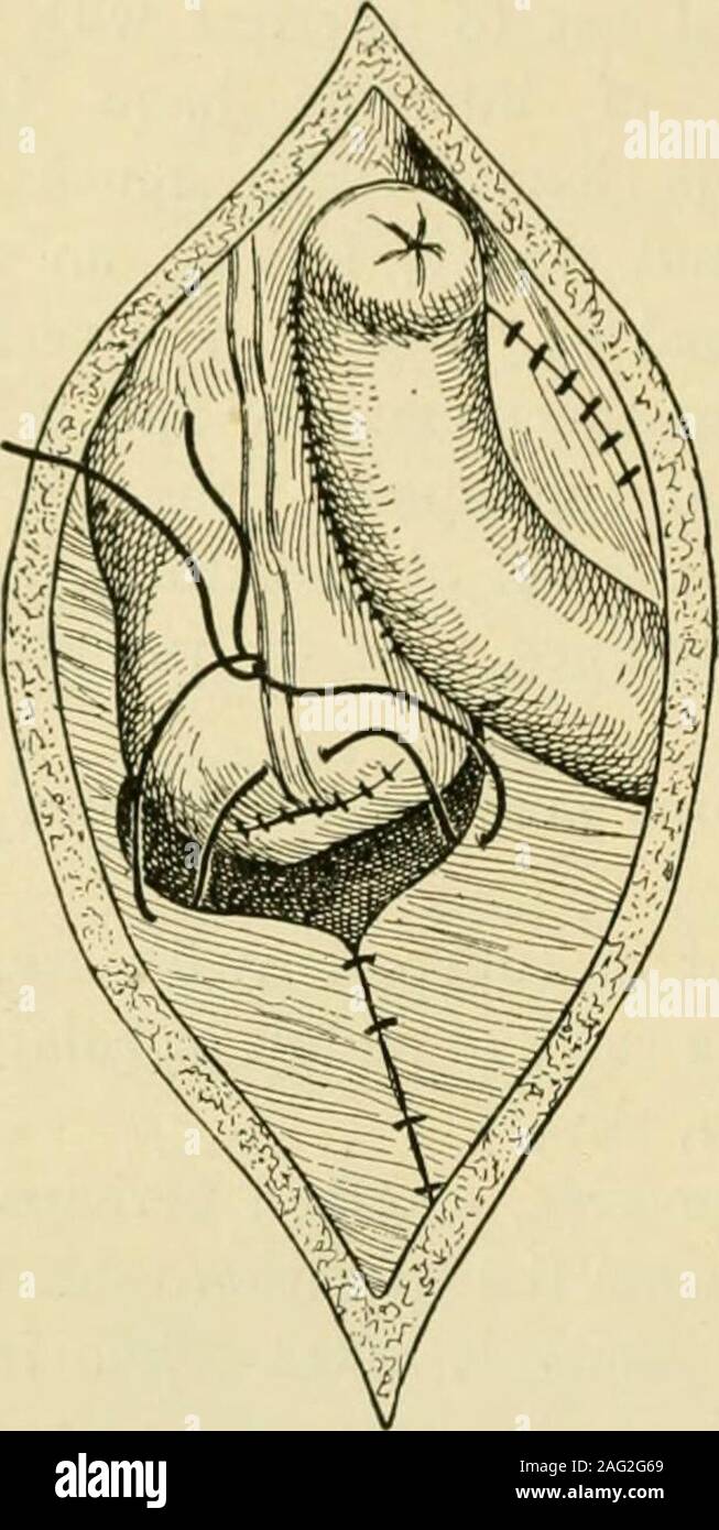 . Manual of operative surgery. at the outer side of thecaecum and ascending colon. Free the caecum from its bed by finger dissection.Ligate and divide the branches of the ileocolic artery to the necessary extent.Completely mobilize the diseased segment of gut. The caecum may be somobile, i.e., so well provided with mesocaecum, that ligatures or clamps maybe applied directly without preliminary dissection. 426 OPERATIONS ON THE INTESTINES Step 3.—Treat Ihe mobilized gut as in Pauls colectomy or proceed asfollows: With two crushing forceps applied about i inch apart strongly clamp theileum at a Stock Photo