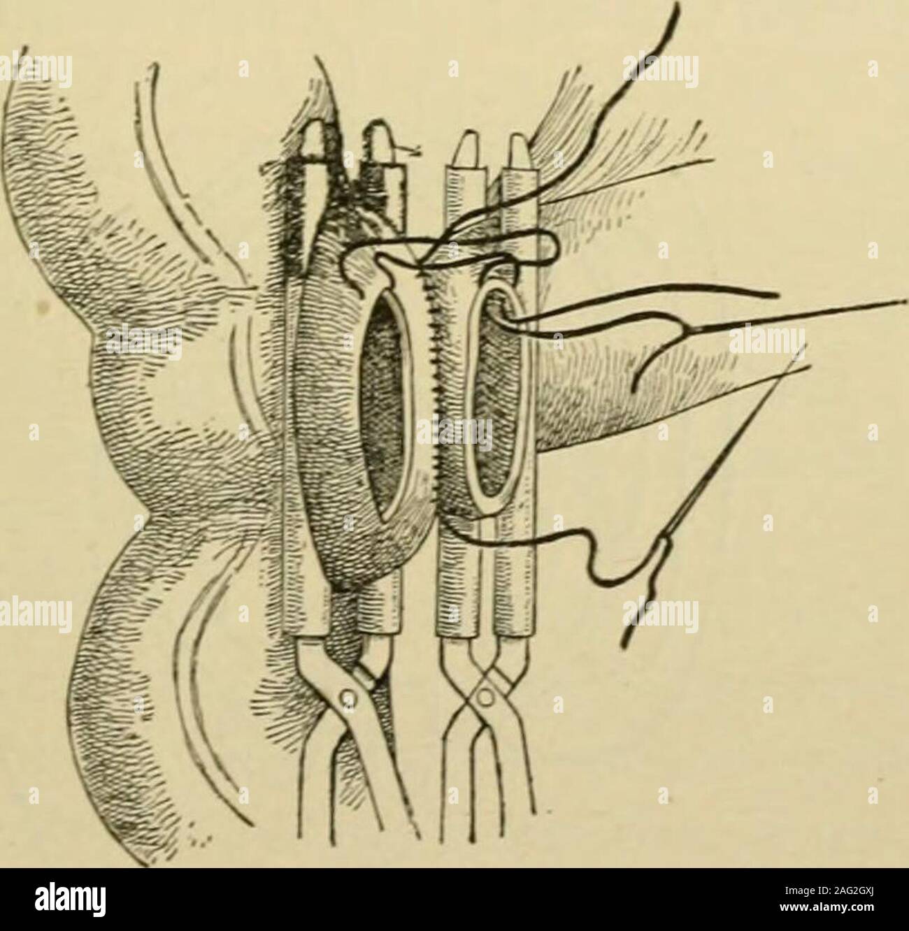 . Manual of operative surgery. Fig. 573.Figs. 571, 572 axd 573.—Use of Murphys button. (DaCosla.). Stock Photo