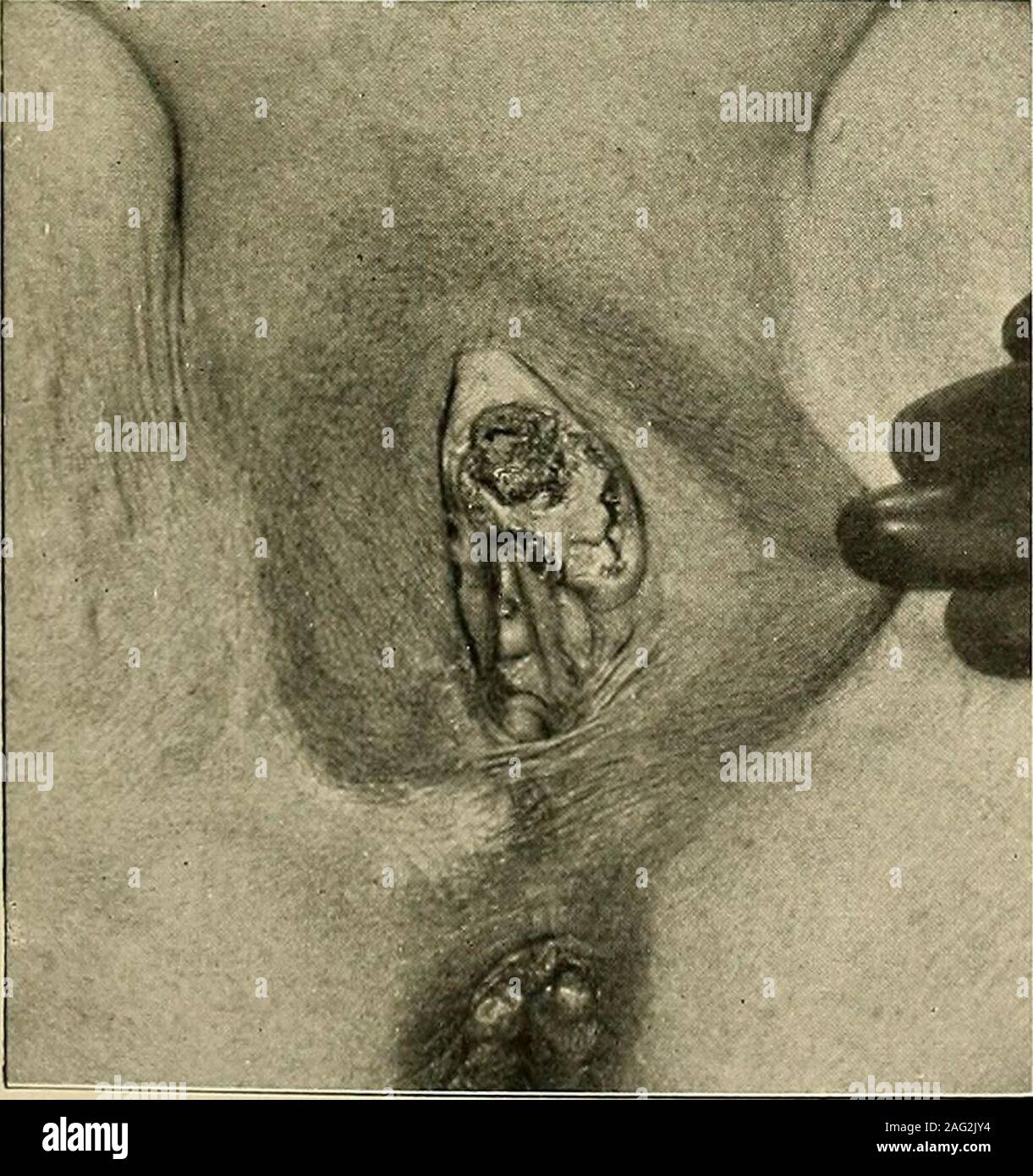 . The diagnosis and treatment of diseases of women. Fig. 220. An Epithelioma of the right labium. (Hirst—Diseases of Women.). Stock Photo