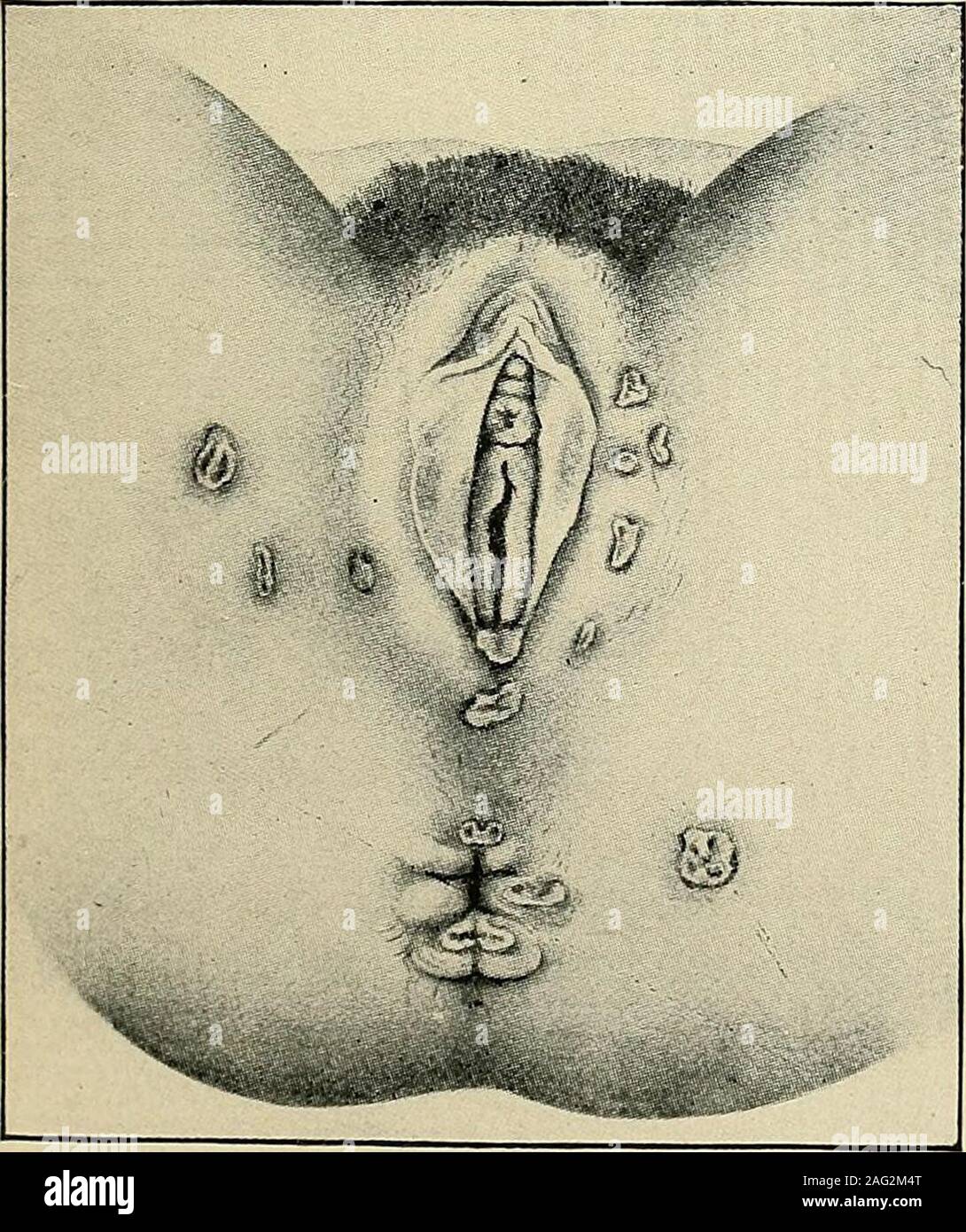 . The diagnosis and treatment of diseases of women. Fig. 217. Kraurosis Vulvae. CHivst- Diseases of Women.) not, the affection is, for the time being, given the above name. Kraurosis Vulvae (Fig. 217) is a peculiar neuro-atrophic condition of the externalgenitals, usually preceded by a long period of pruritis. The skin becomes atrophicand has a bleached and drawn and withered appearance. It is seen most frequentlyin elderly women, and is usually accompanied by intense pruritis, as attested by the history of the case and by the abra-sions from scratching. ULCER ON EXTERNAL GENI-TALS. Simple Ulc Stock Photo