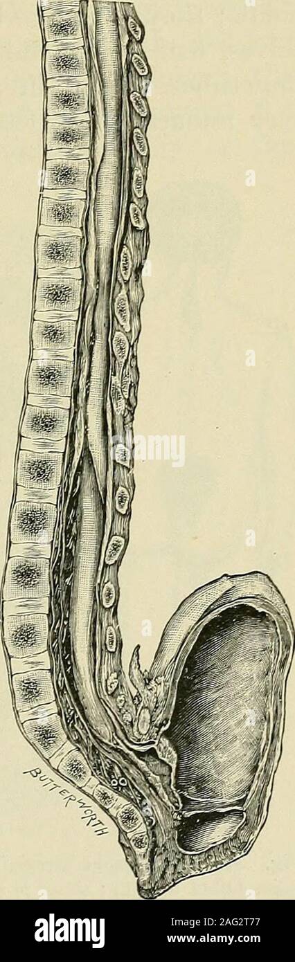 . Tumours, innocent and malignant; their clinical characters and appropriate treatment. cation of the bones of the cranialvault. In contrast, it should bementioned that the bone beneaththe exquisite crest of the crownedcrane is abnormally thick. Animportant condition often associ-ated with spina bifida occulta isperforating ulcer of the foot. In-deed, this association is now sowell recognized that in every caseof perforating ulcer of the foot,occurring in young patients, it isthe duty of the surgeon, as amatter of routine, to examine theloins. In addition to non-union of thearches in the vicin Stock Photo