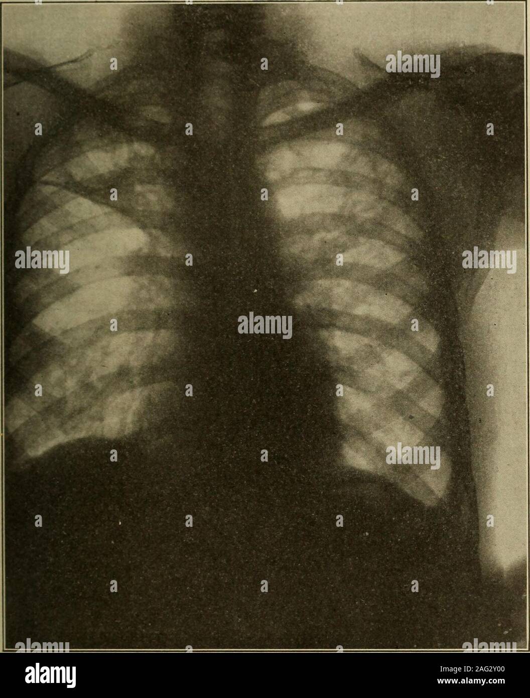 . Medical diagnosis for the student and practitioner. Fig. 128.—Pulmonary Tuberculosis with Cavitation. {Dr. Frank S. Bissell.) lies in the accuracy with which may be demonstrated the extent of thedisease, the presence and nature of complications, as well as other factors inprognosis. The extent of involvement of a lung is usually found greater thanphysical signs or symptoms would lead one to suspect because so many of thelesions lie in the deeper portions of the lung where they escape the detection ofthe keenest clinician. ROENTGENOGRAPHS EXAMINATION OF LUNGS AND PLEURA 310 Cavities.- -Cavita Stock Photo