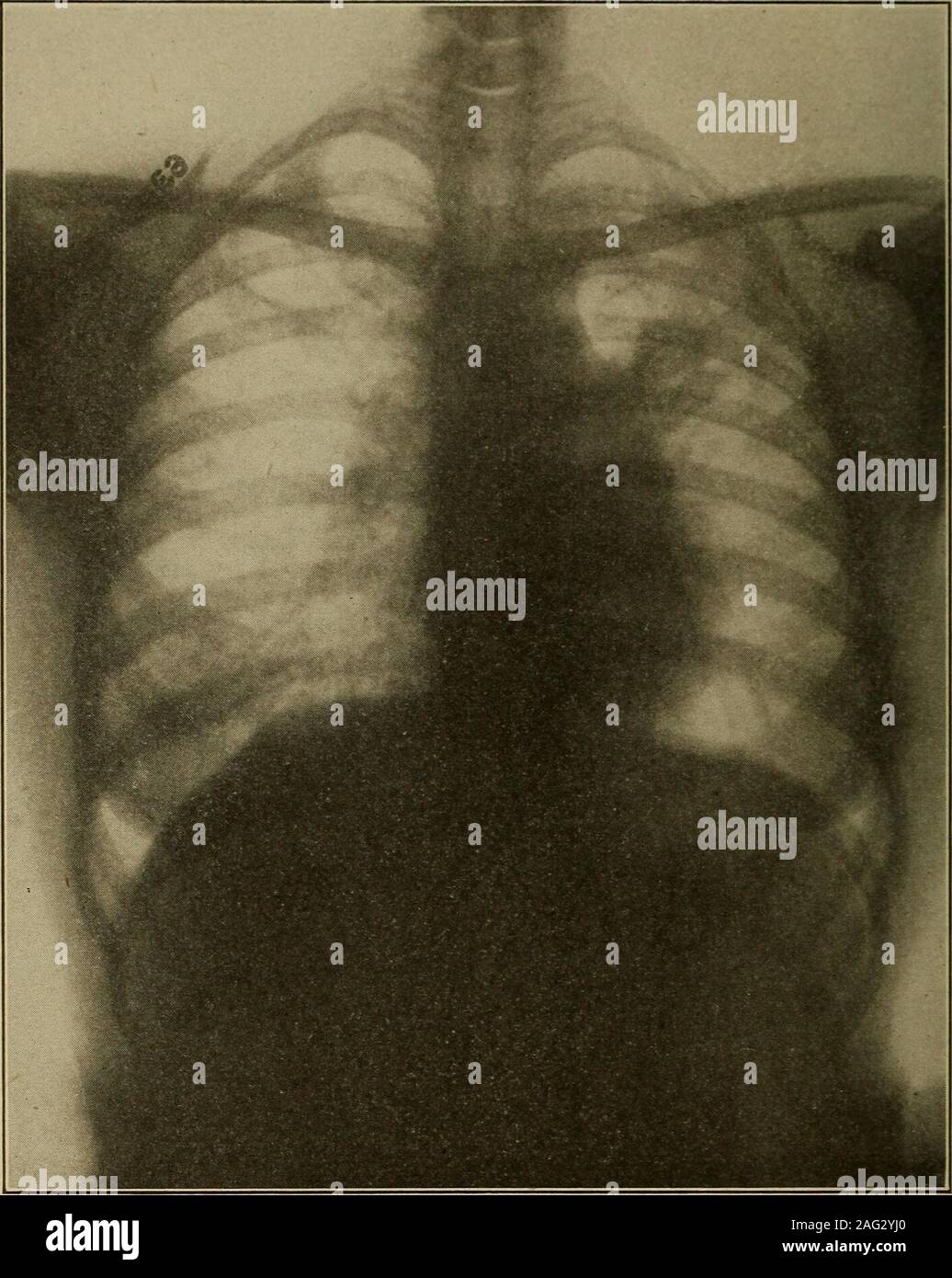 . Medical diagnosis for the student and practitioner. Fig. 127.—Apical Tuberculosis—Healed or Latent. Note that lesions are closely cir-cumscribed by apparently normal lung. {Dr. Frank S. Bissell.) This is true because the more characteristic changes tend to becomemasked by the effects of fibrosis and mixed infections. Usually, however,the distribution of the lesions points the way to a correct diagnosis or somearea of slight involvement is found where the changes are more typical. Compensatory emphysema frequently exists in some degree, manefesting Emphysema. 3i8 MKDICAL I)IA(;OSIS itself ch Stock Photo