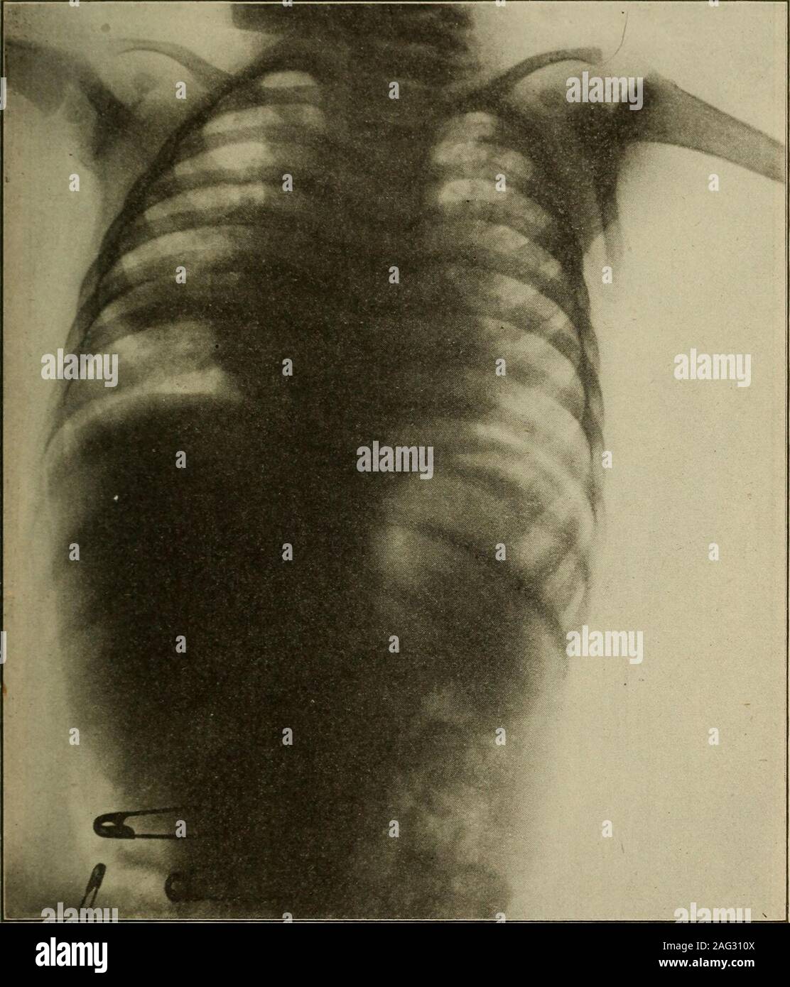 . Medical diagnosis for the student and practitioner. erculosis.—Mottling of the Pulmonary Field in Early Cases.—Normal peribronchial glands do not obstruct the rays sufficiently to cast a shadow,but when they become swollen, as the result of bacterial invasion, they appear asfine nodules, which, increasing in number, tend to give the lung field a mottledappearance. While this mottling is observed early in many cases of tuberculosis, itis by no means characteristic of this disease but points only to some infectionor irritation of the bronchi. Tuberculosis of the adult type tends very early to Stock Photo