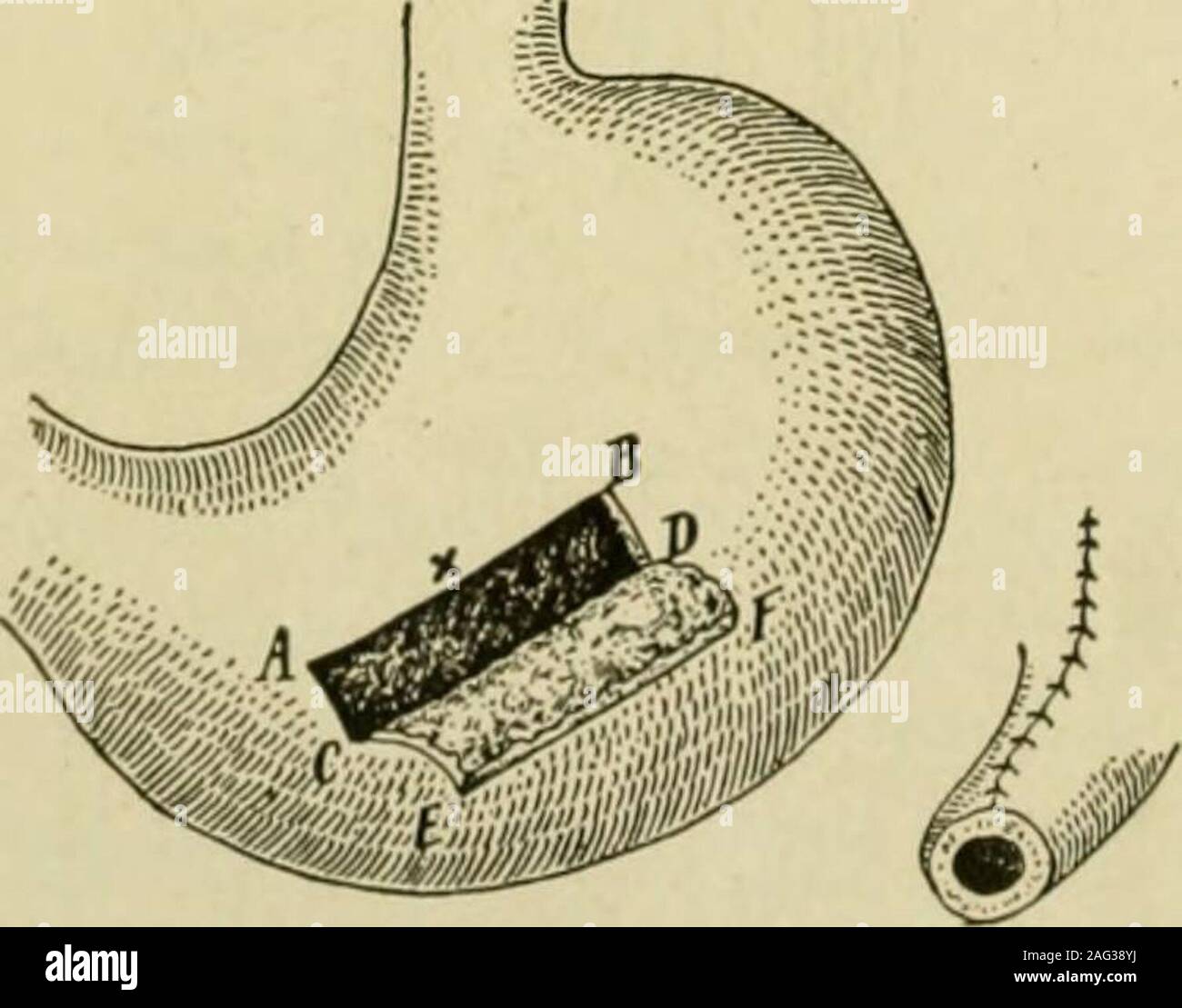 Gastrostomy hires stock photography and images Alamy