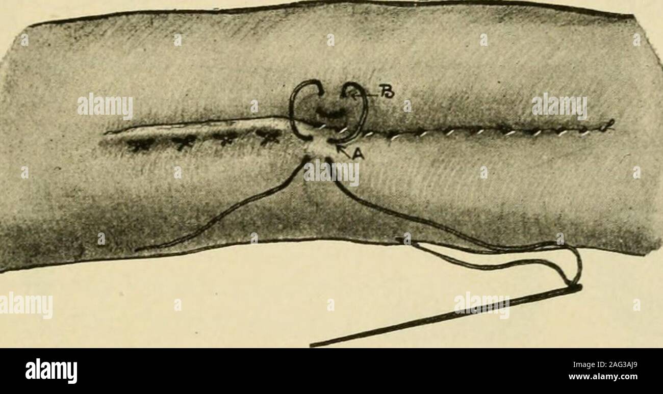 . Manual of operative surgery. Fig. 462.—Mattresssuture. {Monod andVanverts.). Fig. 463.—Alfred H. Goulds mattress stitch. Note that the loop is reversed. This results in the rolling in of the peritoneum on the side of the loop—B drawn to A. a few fibres of the submucosa without letting theneedle pass into the mucosa seems to be an iridescentdream. The blood-vessels lie in the submucosa, andin suturing unless the thread is passed under the vessels(i.e., nearer the mucosa) the stitches will exercise nopressure upon them and thus serious hemorrhage may,and sometimes does occur. In inserting sutu Stock Photo