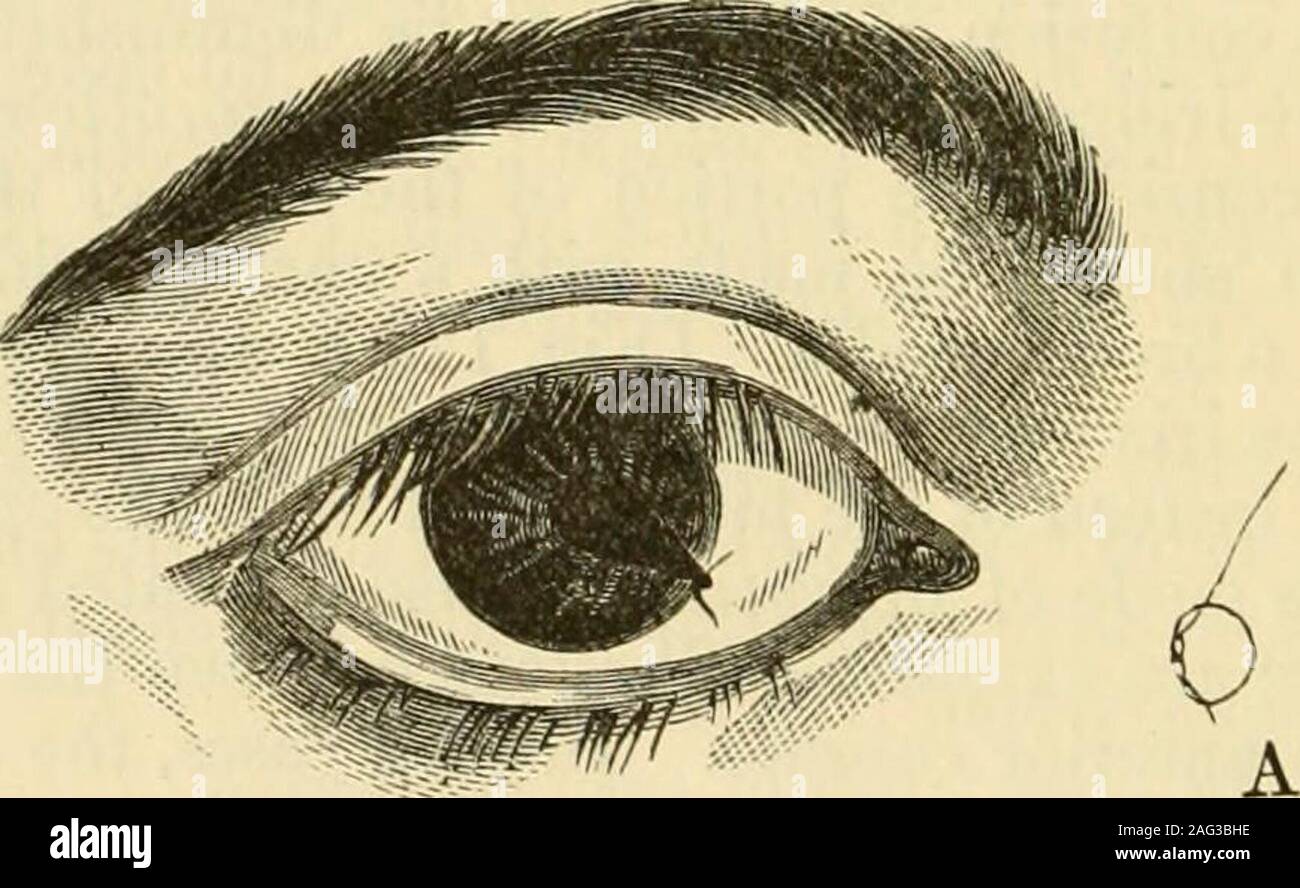 . A treatise on the diseases of the eye. cataract, etc. The operation ...
