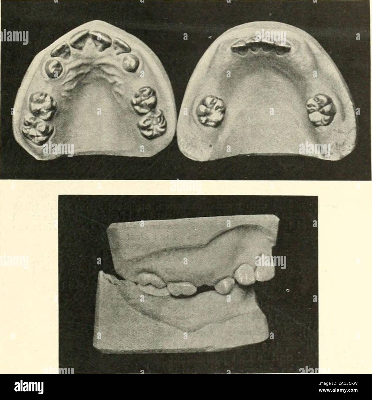 Molars mandible hires stock photography and images Alamy