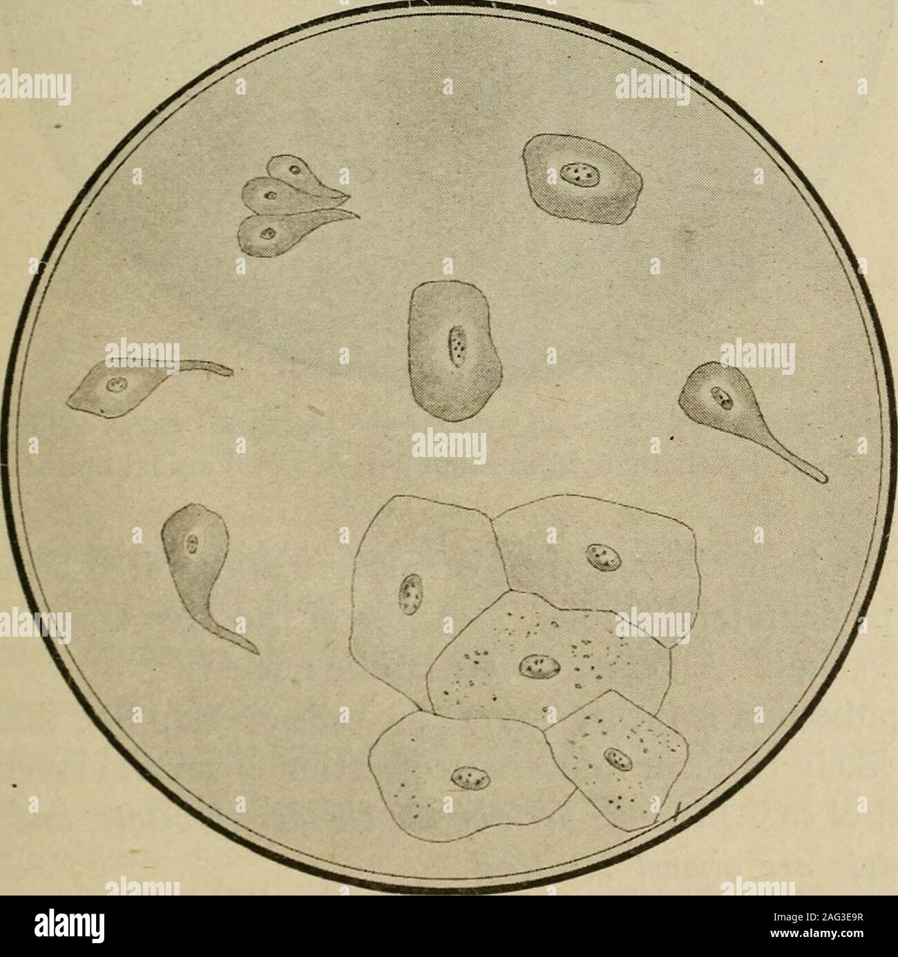 . Medical diagnosis for the student and practitioner. FiG. 78.—Renal cells. Various forms, including compound granule cells.. Fig. 79.—Bladder epithelium. {Various forms.) lar shape, being sometimes polygonal or cubicular, but, as contrasted withthe leucocyte, all renal cells are mononuclear * * Degenerated cells may of course show no trace of a nucleus. Alwaysmononuclear. 2& MEDICAL DIAGNOSIS Pelvic cells. Pavementepithelium. Significance. In cases of obstructive jaundice the renal cells are often distinctly bile-stained. Caudate cells arranged in overlapping layers are often described as the Stock Photo