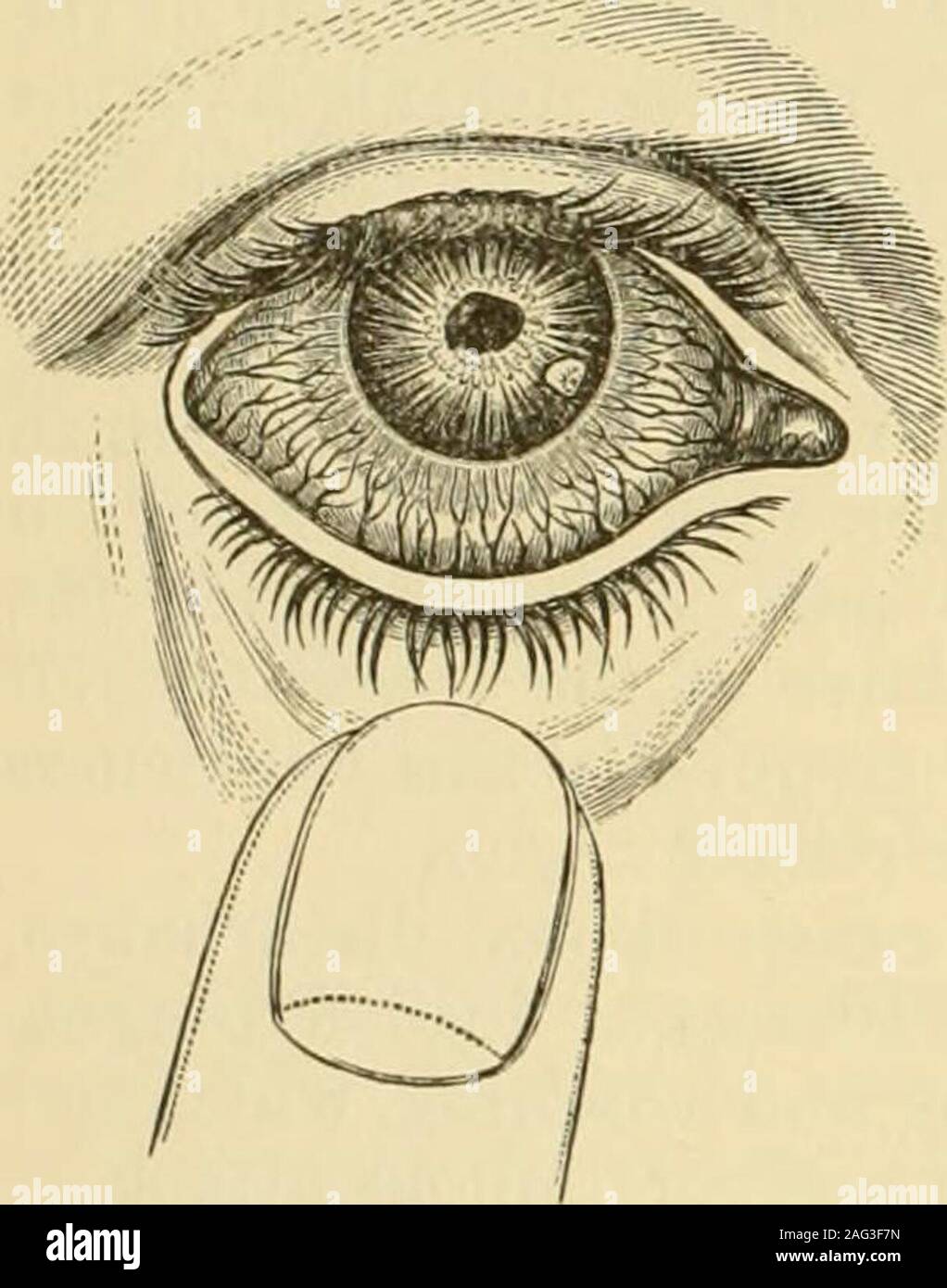 . A treatise on the diseases of the eye. partial, the immobility of the pupil may be the same. In testing themobility of the pupil, the patient should be placed so that the light fallssideways upon the eye. The other must be firmly closed with our hand, orby a handkerchief. The affected eye is to be shaded with the palm of ourhand, which is then to be rapidly removed so as to admit the light, and thebehavior of the pupil accurately watched, so that its size, mobility, and theextent of its contractions may be ascertained. It must be remembered thatcontraction and impaired mobility of the pupil Stock Photo