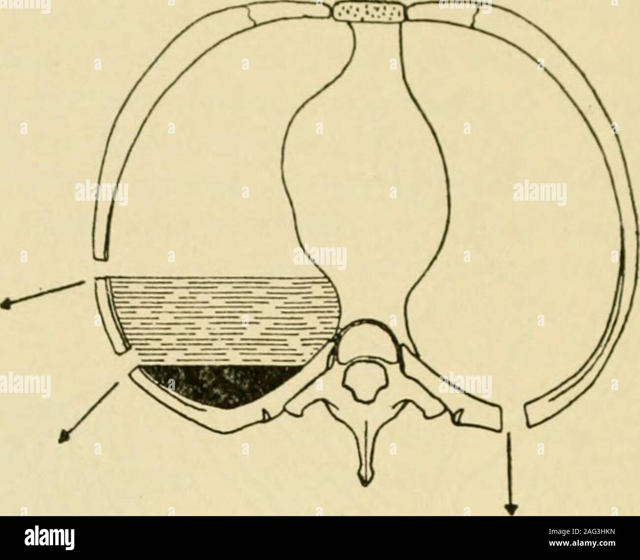. Manual of operative surgery. Fig. 424.—Segment of the 6th rib has ...