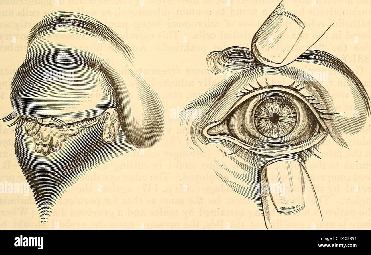 Swollen conjunctiva hires stock photography and images Alamy