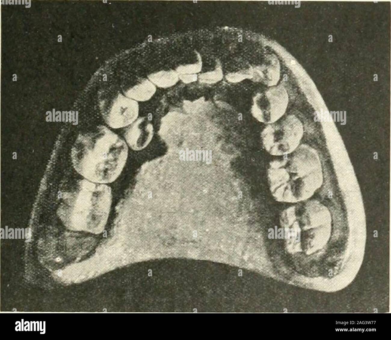 The Science And Practice Of Dental Surgery Fig 145 Flattening Of Arch Backward Movement Of Leftlower Canine And First Premolar And Lingual Displacementof Second Prenaolar Due To Premature Loss Of Seconddeciduous Molar