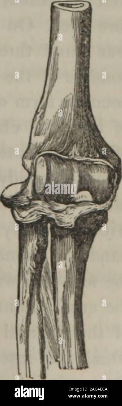 . A treatise on dislocations and fractures of the joints. ent which I have never seen in the livingbut in the winter of 1821, a man was brought for dissectiontheatre of St. Thomass Hospital, in whom was foundthis dislocation, which had never been reduced. Thehead of the radius was thrown behind the externalcondyle of the os humeri, and rather to the outer sideof the lower extremity of that bone. Mr. Sylvester,of Gloucester, who was at that time a very intelligentstudent, had the kindness to make me a drawing ofthe parts as they were dissected, and the appearancesare seen in the accompanying fi Stock Photo