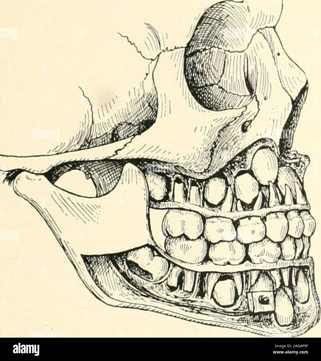 . The science and practice of dental surgery. r plate has been removed to showthe extent of calcification of the permanent teeth.(Odontological Museum, Royal College of Surgeonsof England.) traced at this period in the roots of the deciduousincisors. The crypts of the first permanentmolars are widely open and their contained 27 teeth have become partly extruded through,the overlying gum alone remaining intact. Thecrowns of the incisors are complete, excepttowards the cervical margin, where the enamelmay present the dull, lustreless, appearance indi-cative of incomplete calcification (see Figs. Stock Photo