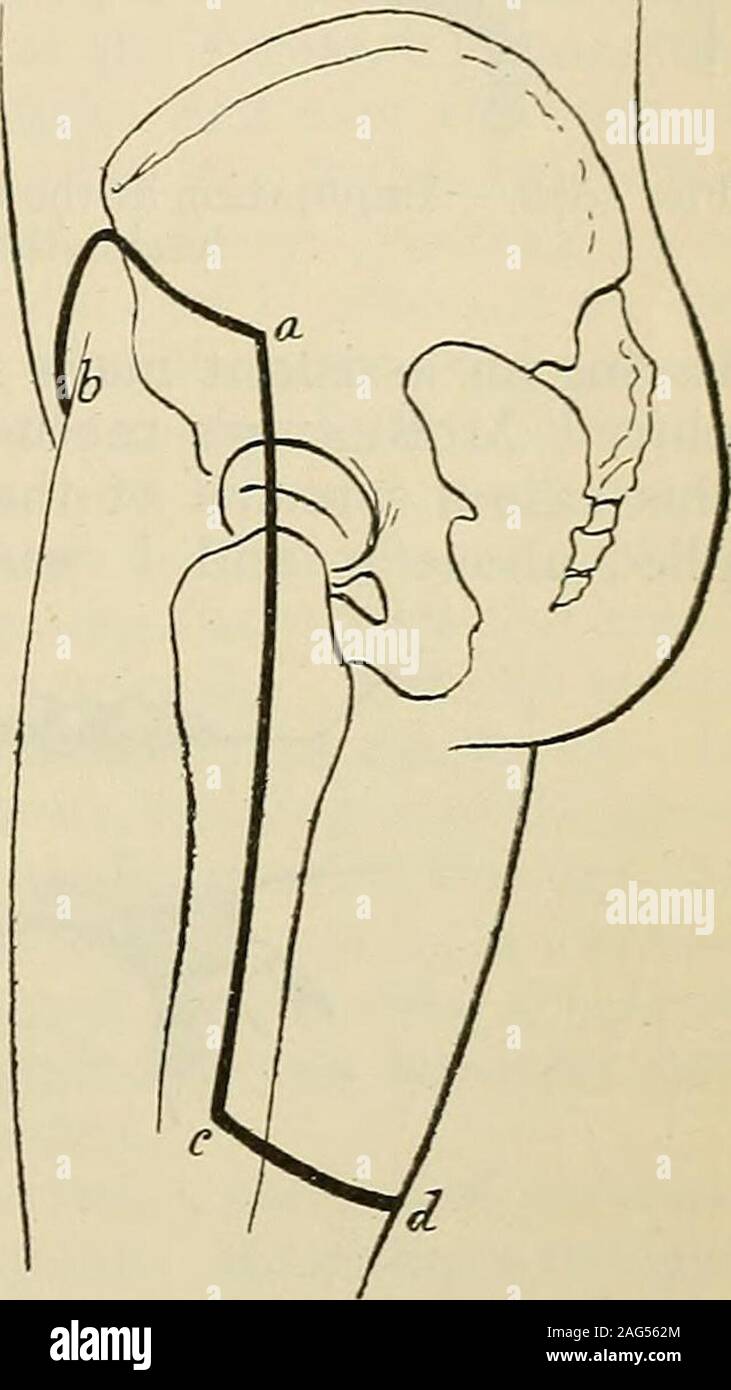 . Modern surgery, general and operative. Fig. 1076.—Macewens method for compressionof the abdominal aorta (American Text-bookof Surgery). Fig. 1077.—Posterior flap inauthors unusual case requiringhip-joint amputation: a—b. Theanterior incision; a-c-d, the ex-ternal incision and the begin-ning of the posterior cut. case, compression so situated fails to intercept the blood-current in a number oflarge vessels. Various other methods have been employed. It was formerly the customto compress the aorta by means of an abdominal compressor (Figs. 1074, 1075).A tourniquet is very likely to be displaced Stock Photo