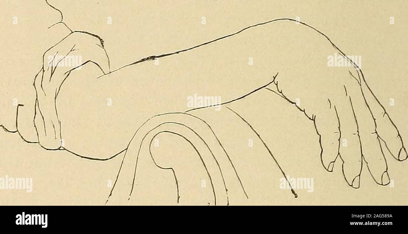 . A manual of diseases of the nervous system. All these are 106 SPINAL NER7ES. paralysed by a complete lesion of the nerve near the brachial plexus.When the lesion is near the middle of the humerus, as it is in mostcases of compression, the triceps generally escapes, but not always.The supinator longus is usually paralysed, but escapes if the lesionis below the origin of its branch, and may also escape if the injury tothe nerve is incomplete. In sleep palsy it usuully suffers, but I haveseen it unaffected, in a case in which the ext. carpi radialis was alsobut little affected, and Bernhardt ha Stock Photo