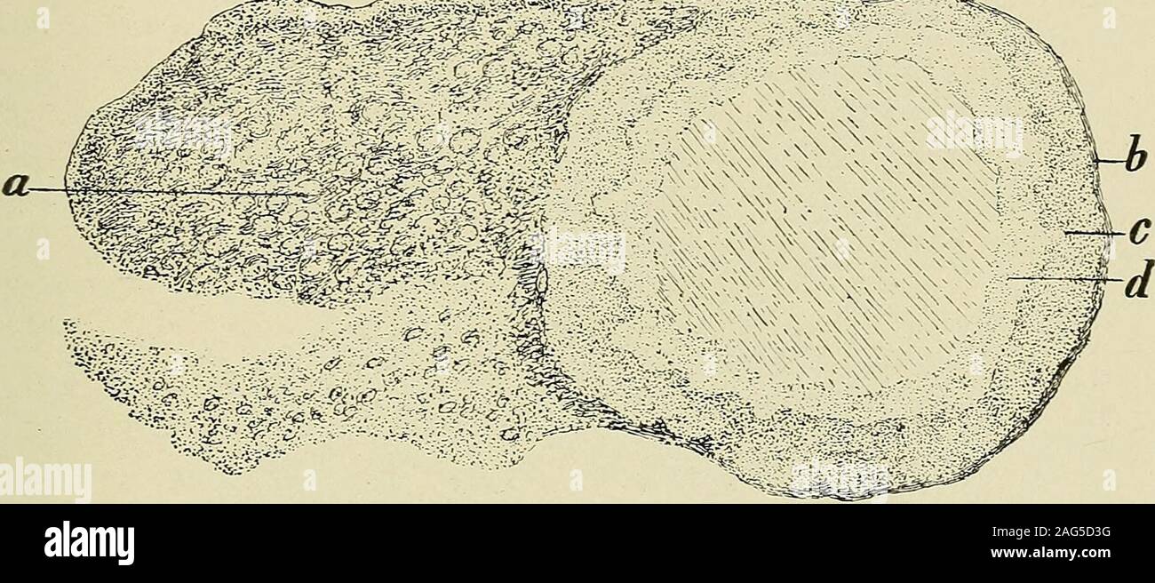 . Gynecological pathology; a manual of microscopic technique and diagnosis in gynecological practice, for students and physicians. on, may continue, under circumstances which we do notyet understand, and may lead to the formation of cysts of the corpus CORPUS-LUTEUM CYSTS. 151 luteuni. These, as a rule, do not attain any considerable size, so thata growth the size of a fist is rare. Macroscopically we can recognize the irregular wavy surface ofthe inner wall of this cyst. In section the wall is seen to be of con-siderable thickness, and the wavy elevations extending toward the cystinterior loo Stock Photo