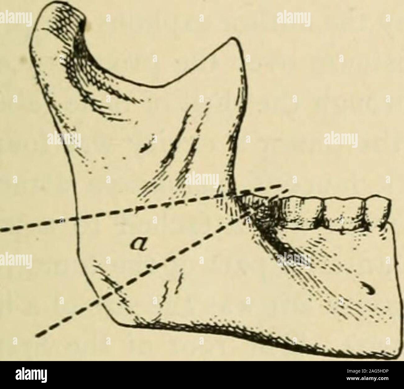 Manual of operative surgery. , the coronoid process,the incisura semilunaris,  the zygoma, etc. As a consequence simple divisionof the articular process  is insufficient to give motion, and even when combinedwith osteotomy