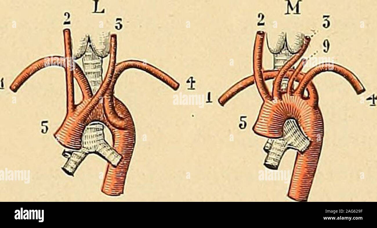 . Traité d'anatomie humaine : anatomie descriptive, histologie, développement. Fig. 657. Variété? dorigine des troncs sus-aorliqucs chez lhomme (daprès Tiedmakk). 1, sous-clavicre diôHe. — 2. carotide primitive droite. — 3, carotide primitive gauche. — 4, sous-clavière gauche. -6, tronc brachio-céphaliquc. — 7. tronc innominé. — S. vertébrale droite. — 9, vertébrale gauche. sincurvait en arrière, descendait le long de la colonne vertébrale et se terminait par lartèreiliaque primitive droite ; quanta laorte postérieure, elle fournissait le tronc brachio-céphaliqueet les artères carotide primiti Stock Photo