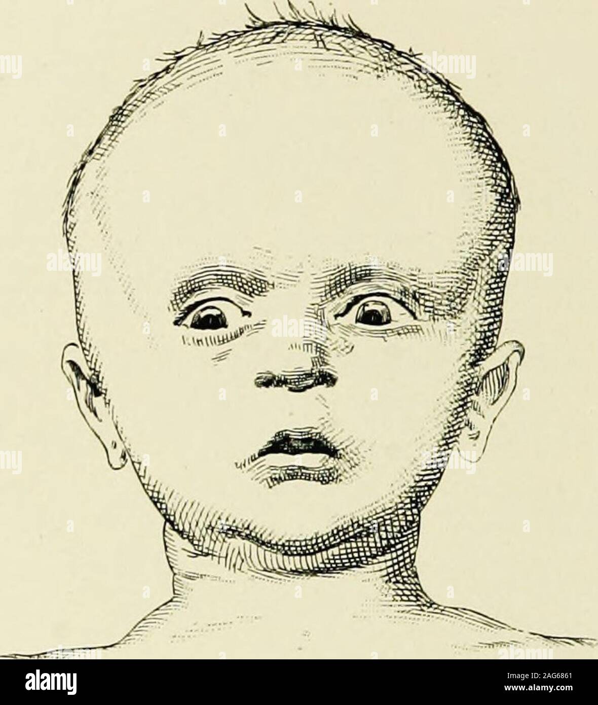 Bulging fontanelle hires stock photography and images Alamy