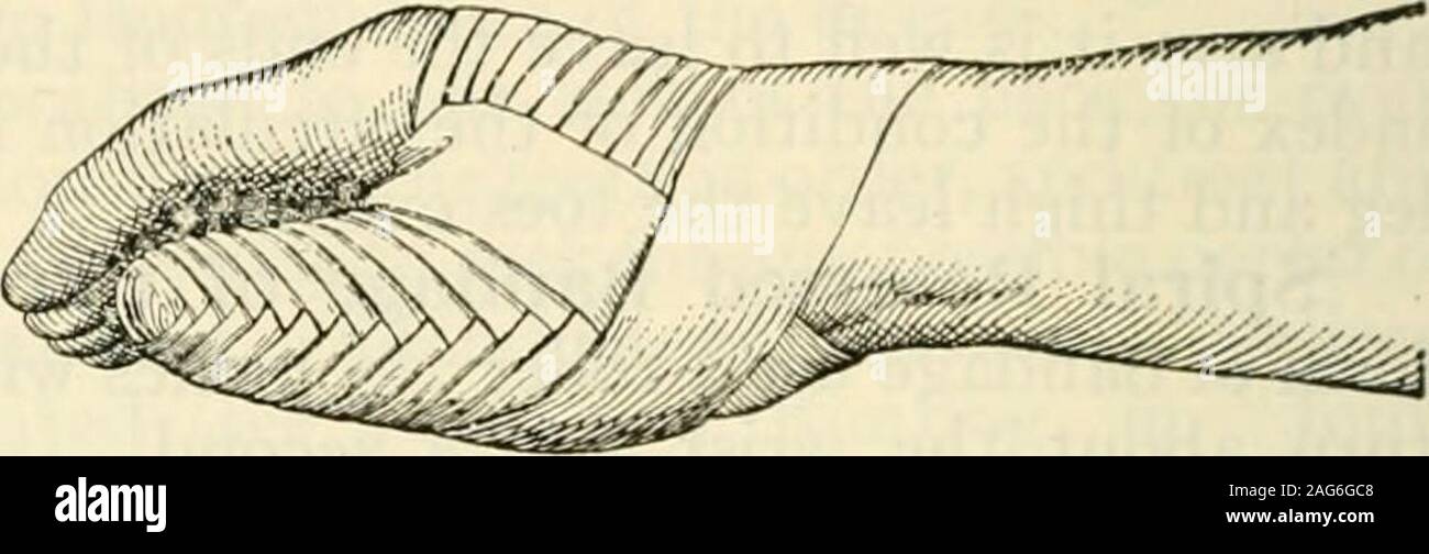 Modern surgery, general and operative. Fig. 901.—Spica of the thumb.. Fig.  902.—Selvab thumb bandage applied. thumb and index-finger. The roller is  returned in a recurrent manner to itsplace of origin, overlaps