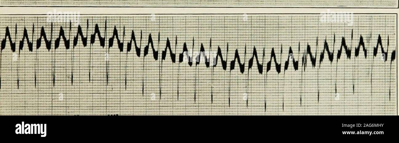 . The diseases of infancy and childhood : designed for the use of students and practitioners of medicine. HffiiiHiiiili. Fig. 180.—Electrocardiogram. Female, aged three years. Paroxysmal tachycardia.A ventricular beat of 250 per minute. P-waves cannot be identified, probably combinedwith T-waves. Heart action is regular. Impulses during the paroxysms of tachycardiaare probably supraventricular in origin. Prognosis.—The prognosis varies; as a rule it is favorable, deaths inthe attack are scarce and the more favorable prognosis lies in attacksat long intervals. Treatment.—Treatment as to the att Stock Photo