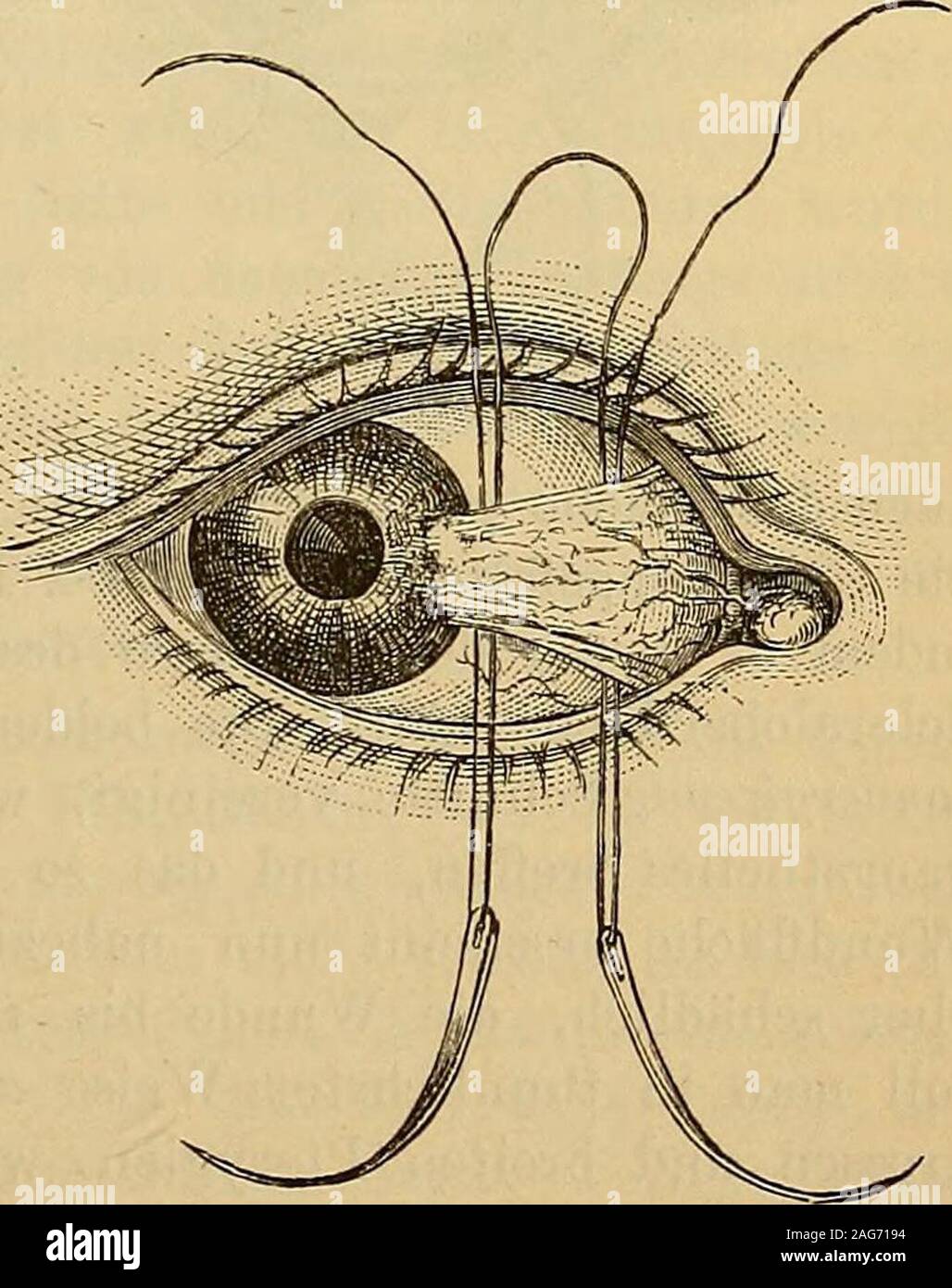 Lehrbuch Der Praktischen Augenheilkunde. In Letzterer Beziehungdie  Bepinselung Der Wuchernden Bindehautstellen Mit Opiumtinctur, Vor-Nehmlich,  Wenn Diese Letzteren Sehr Aufgelockert, Von Schwammigemansehen Sind, Oder  Wenn Es Gilt, Üppig Wuchernde ...