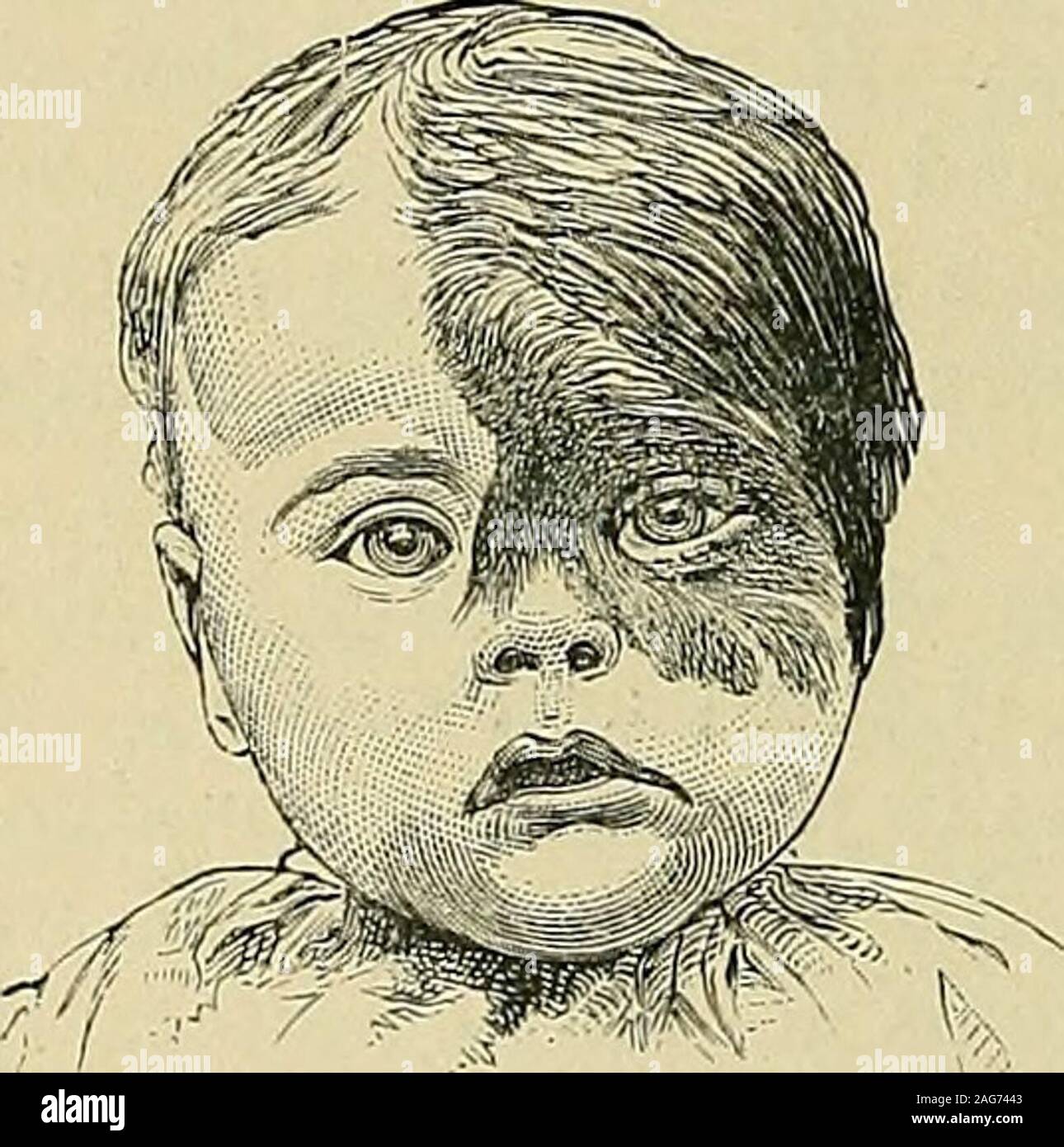 . The diseases of children : medical and surgical. us is one of the mosttroublesome of the skin diseases met with in tuberculous subjects, especiallyas great deformity and disfigurement are often produced by its ravages.On scraping out a lupus tubercle a hollow or pit is seen in the thicknessof the dermis, while at the edge of the patch the superficial part of the skinis undermined. Treatment.—The general treatment is that of tuberculosis, cod-liver oiland arsenic being of especial value. Locally nothing is so effectual asthorough removal of the disease mechanically. It is best to give ananaes Stock Photo
