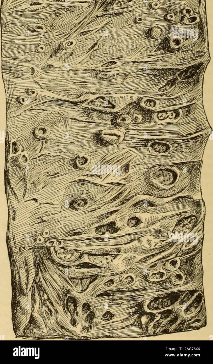 . A Reference handbook of the medical sciences : embracing the entire range of scientific and practical medicine and allied science. Fig. 4131.—Small Tuberculous Ulcers of the Ileum resulting from Tuber-culosis of the Solitary Glands, with following Ulceration. (Naturalsize.) small, hard, whitish nodules covered with an intactmucous membrane. On microscopical examination of the ulcers we findboth a formation of typical miliary tubercles and aninflammatory tissue. The tubercles are seated in thefloor of the ulcer, and in the undermined and elevatededges. Around and between them is a small-cell Stock Photo