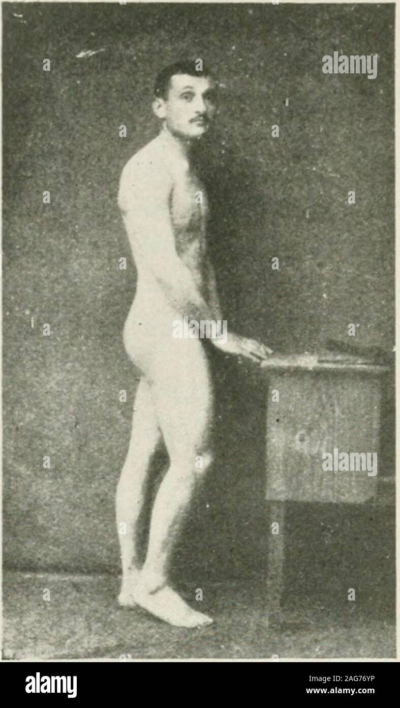 . Medical and surgical therapy. instances, it has followed some slight woundby a bullet or shrapnel ; or it has been of spontaneousorigin after fatigue, exposure to cold, or a rigor(a case of our own coming within the last class). Their Onset is somewhat variable. It is generallyearly. A man is in a trench, at a listening-post, in acommunication-trench or a rest-billet, and is sub-mitted to the explosion of a projectile at short range,such as an aerial torpedo, a mine, or large-calibreshell. He is thrown into the air, falls to the groundor is deeply buried with some of his comrades andloses co Stock Photo