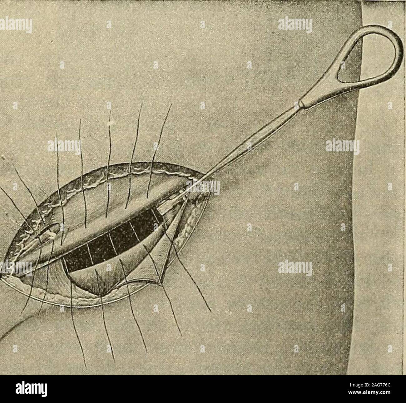 Hernia l femoral hires stock photography and images Alamy