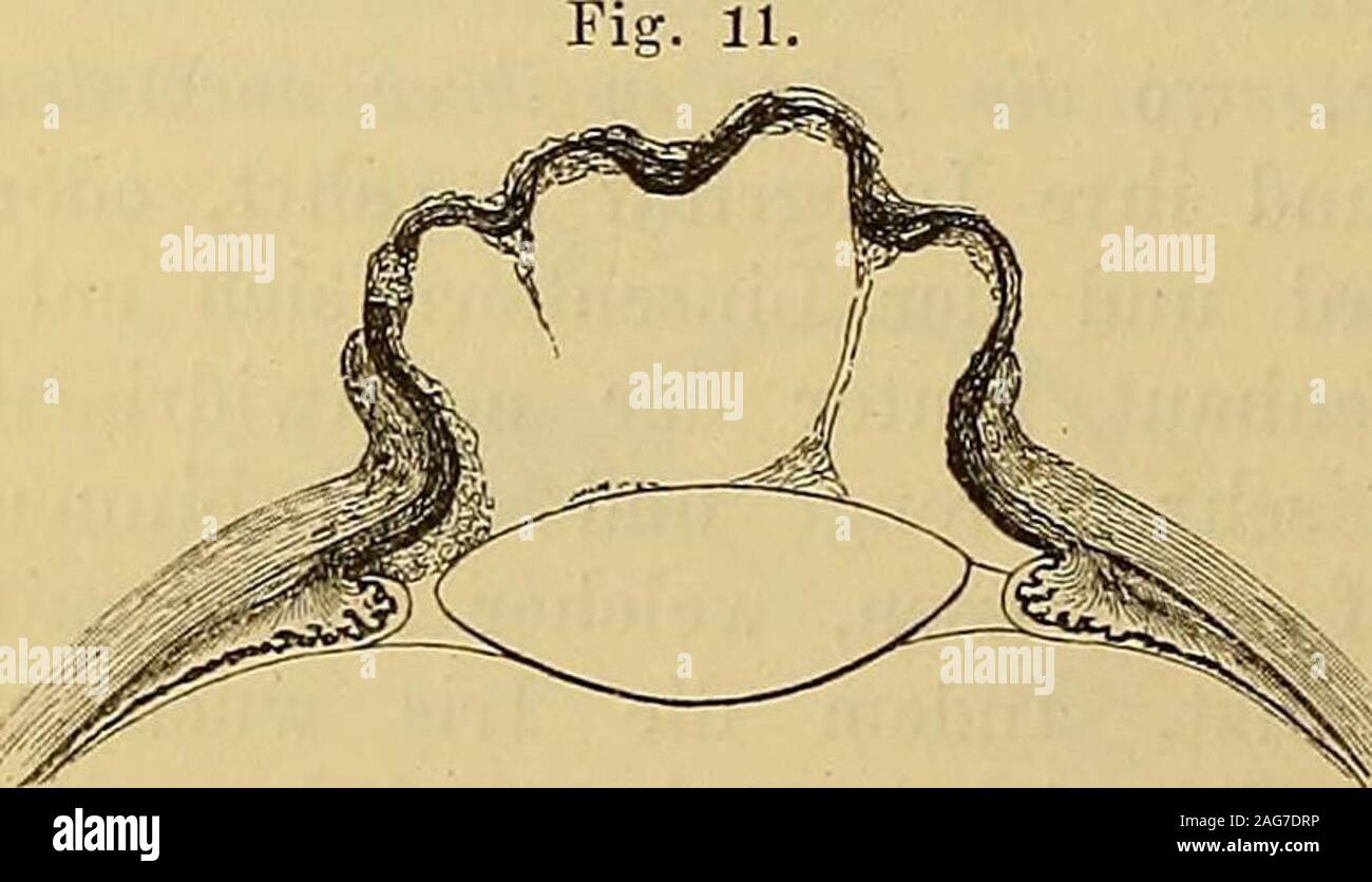 . Lehrbuch der praktischen Augenheilkunde. innt eine ent-fernte Aehnlichkeit mit einer Beeren-traube, daher der Name: Traubenstaphy-lom, Staphyloma iridis racemosum. Das Staphylom der Iris kann berstenund sich wieder füllen, oder aber nacherfolgter Berstung zusammengefaltetbleiben und zur Grundlage einer flachen Narbe werden. Oft jedoch wucherndie Wände des Irisstaphyloms fort und wandeln sich in eine mehr wenigerdicke Narbenmembran um, die ständig ist, es hat sich das Irisstaphylom inein totales Narbenstaphylom der Hornhaut umgebildet. Der Bulbus bleibt dannin der Kegel vergrössert, obgleich Stock Photo