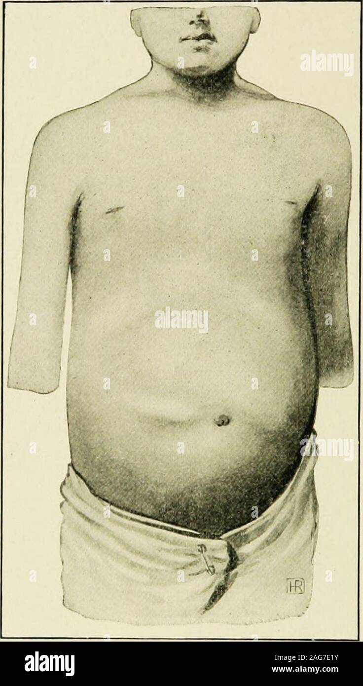 . The diseases of infancy and childhood : designed for the use of students and practitioners of medicine. Fig. 91.—Uniform abdominal dis-tention due to ascites of tuberculousperitonitis; enlarged spleen. 414 THE SPECIFIC INFECTIOUS DISEASES there are encapsulations of fluid, the signs will not vary on changing theposition of the patient. On the other hand, in the adhesive form therewill be evidences of tumor masses in the abdominal cavity, cysticformations caused by the encapsulated exudate, and little or no fluid.In cases of adhesions in tuberculous peritonitis of the miliary form,the fact th Stock Photo