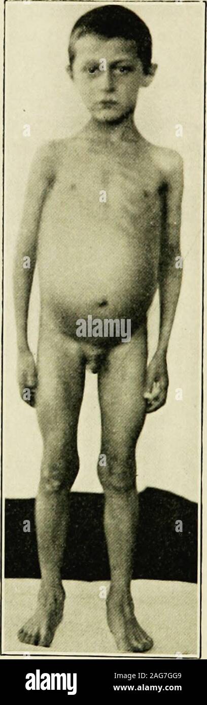 . The diseases of infancy and childhood : designed for the use of students and practitioners of medicine. Fig. SS.—Tuberculous peritonitis,side Wew.. Fig. 89.—Tuberculous peritonitis,front view. may be seropurulent, hemorrhagic, or, in mixed infections, putrid.In the purely ascitic variety the fluid is free; in the purulent form,it is frequently sacculated between the adhesions on the coils of gut.Symptoms.—The disease is, as a rule, insidious and slow hi devel-opment. The stage of abdominal distention has usually been reachedwhen the patient is first brought to the physician. The history show Stock Photo