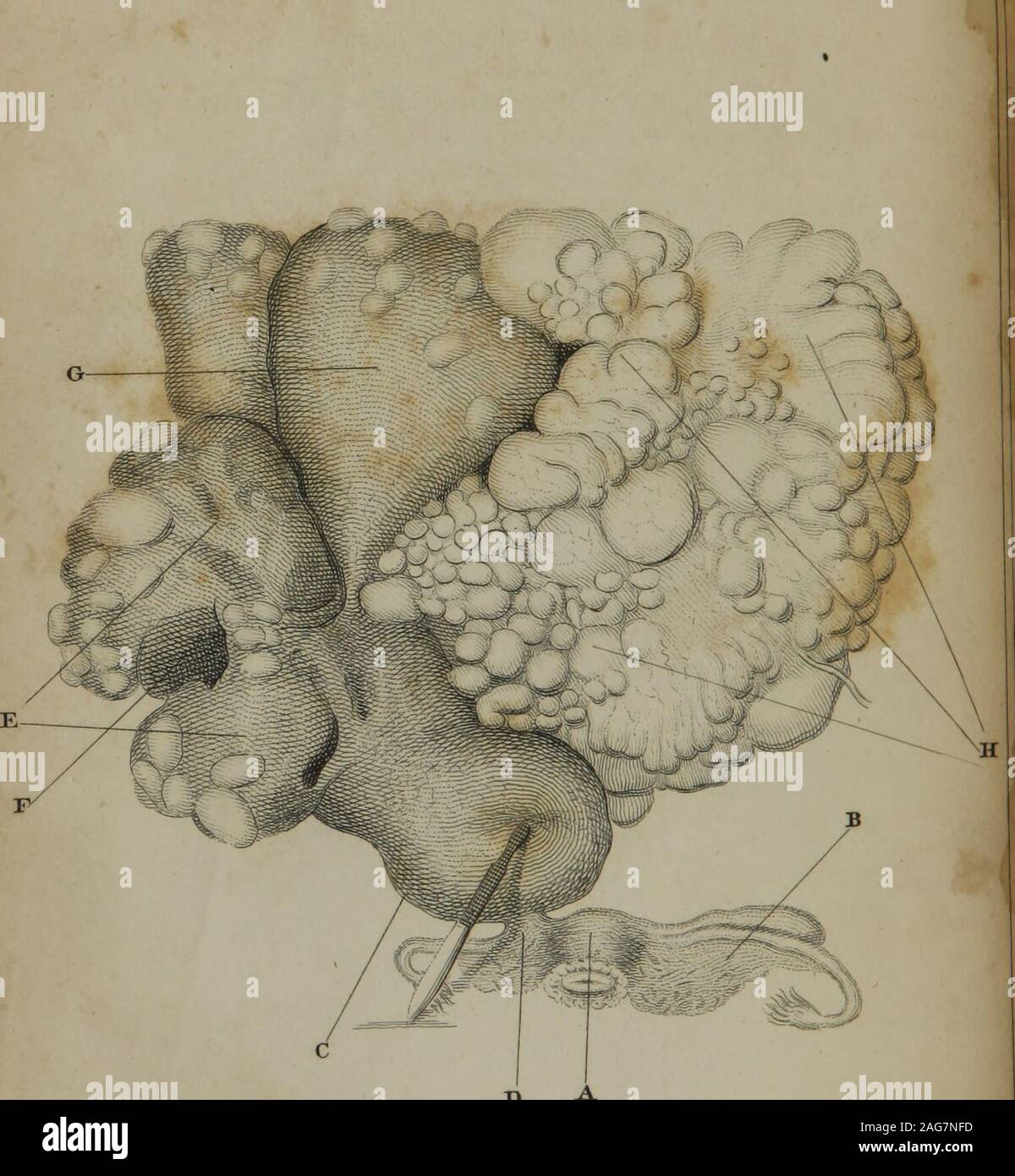 . An introduction to the practice of midwifery. V o Platel7. Francis Case of Ovarian 7)ropsy.. D A J PLATE XVII. ILLUSTRATION OF A DISEASED OVARIUM. [See Note in this Introduction, page 200 ; also, the New-York Medical and Physical Journal, vol. ii. 1823. F.] A The uterus in its natural state. B The broad ligament of the left side, and its appen-dages. C The tumour, immediately attached to the broad liga-ment, dense and sarcomatous, and which occu-pied the pelvic cavity. It is raised up by the knife. D The attachment to the broad ligament, by whichthe whole mass was principally cherished. E Th Stock Photo