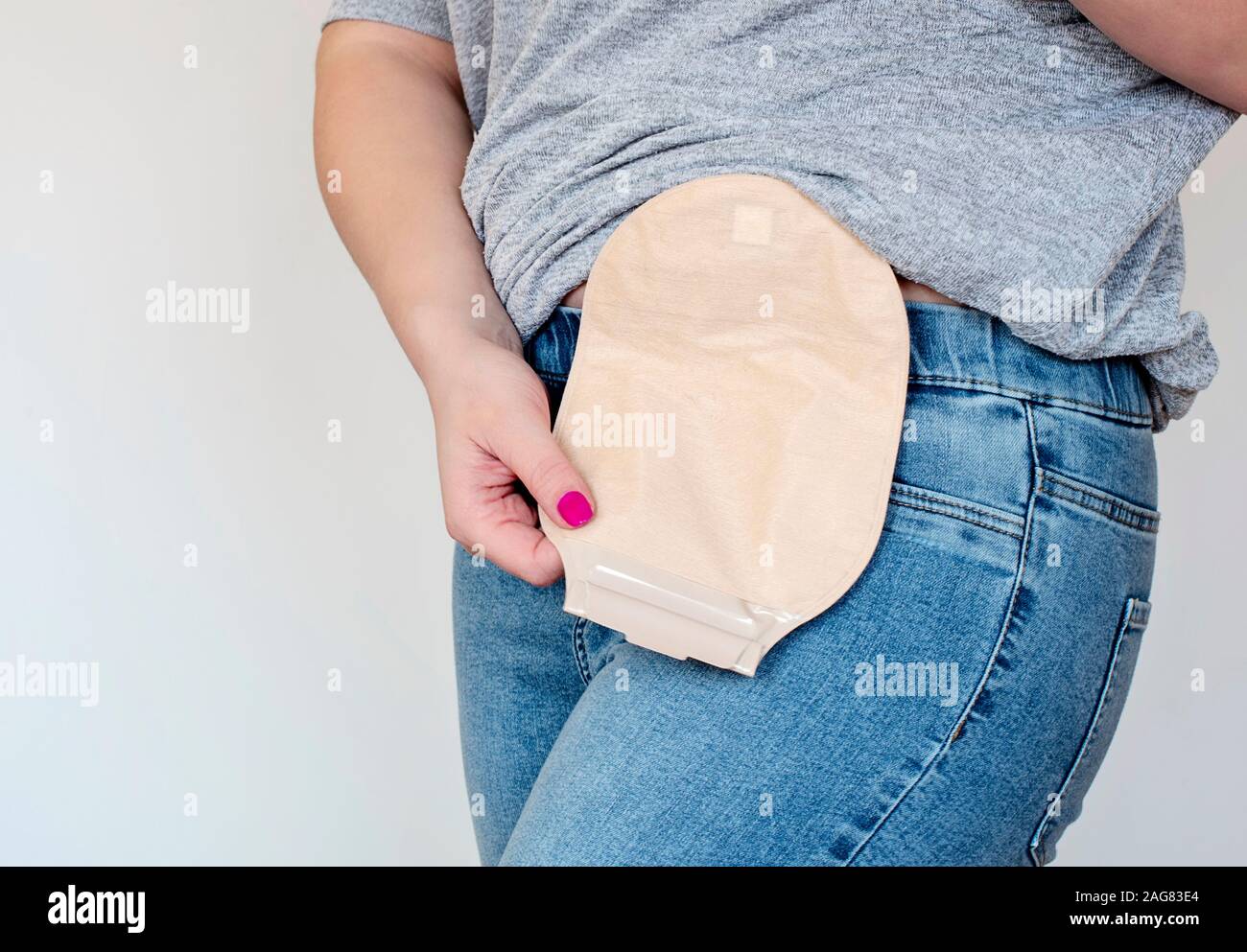 Share more than 149 colostomy bag surgery pictures latest 3tdesign.edu.vn