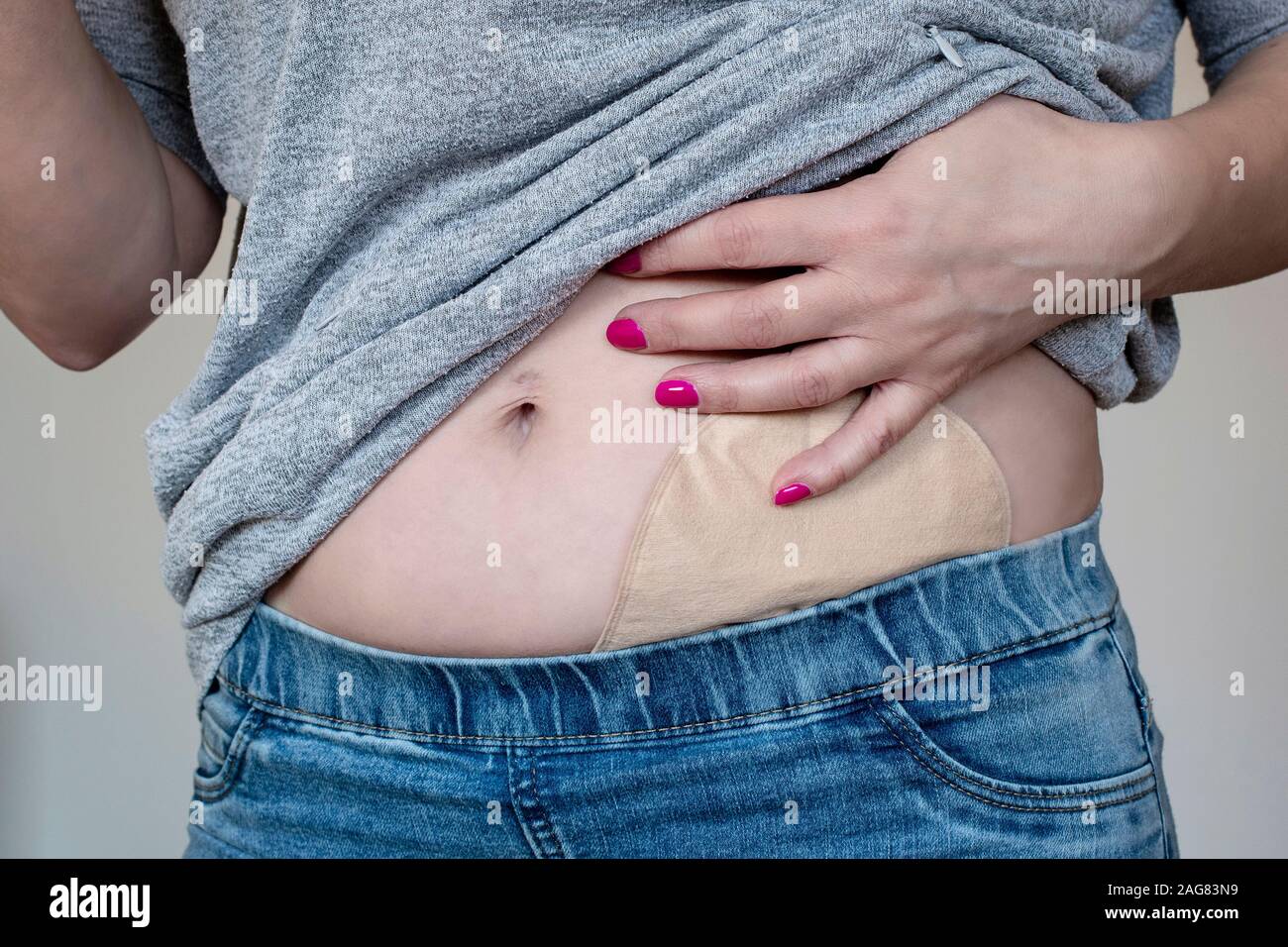 View on colostomy pouch in skin color attached to young woman patient