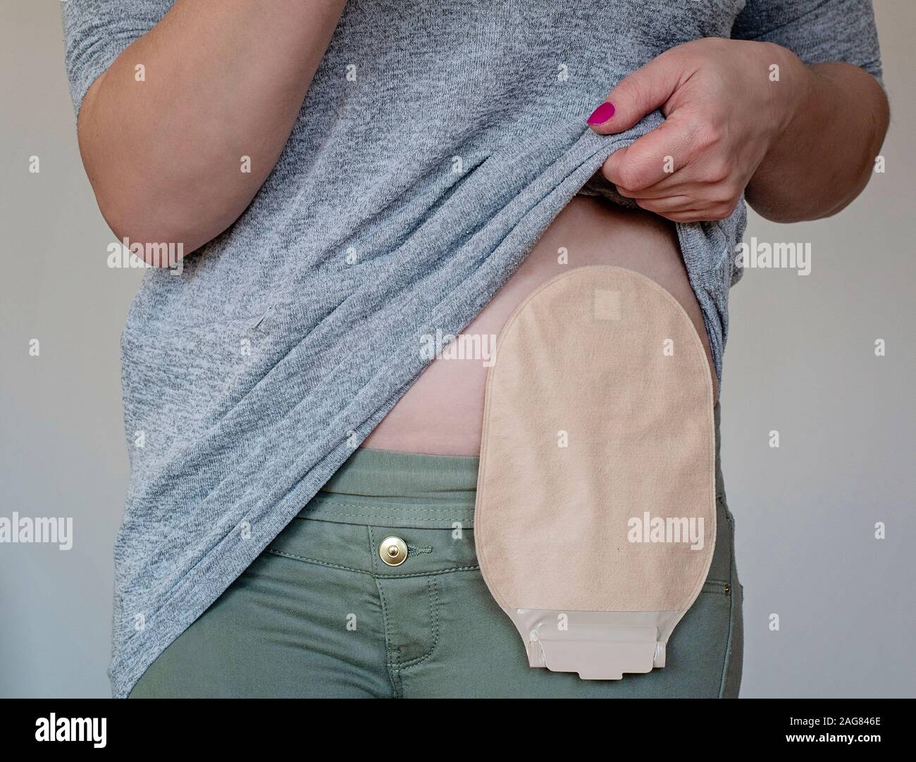 View on colostomy pouch in skin color attached to young woman patient. Closeup on ostomy bag