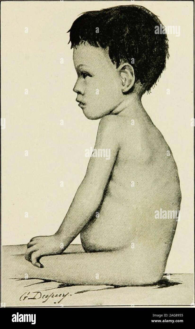 . The diseases of infancy and childhood : designed for the use of students and practitioners of medicine. Rachitis. Showing the cuboldal shape of the head, thethoracic deformity, the beaded ribs, the protuberant abdo-men, and the enlarged lo^A?er end of the radius. RACHITIS 235 inward at the diaphragm at each inspiration. In an attack of severebronchitis or bronchopneumonia, the drawing inward of the sides ofthe chest becomes still more marked. In some cases the sternumalone is affected. There is a sinking of the sternum, with resultingchest deformity. Some forms of rachitis affect only the ri Stock Photo