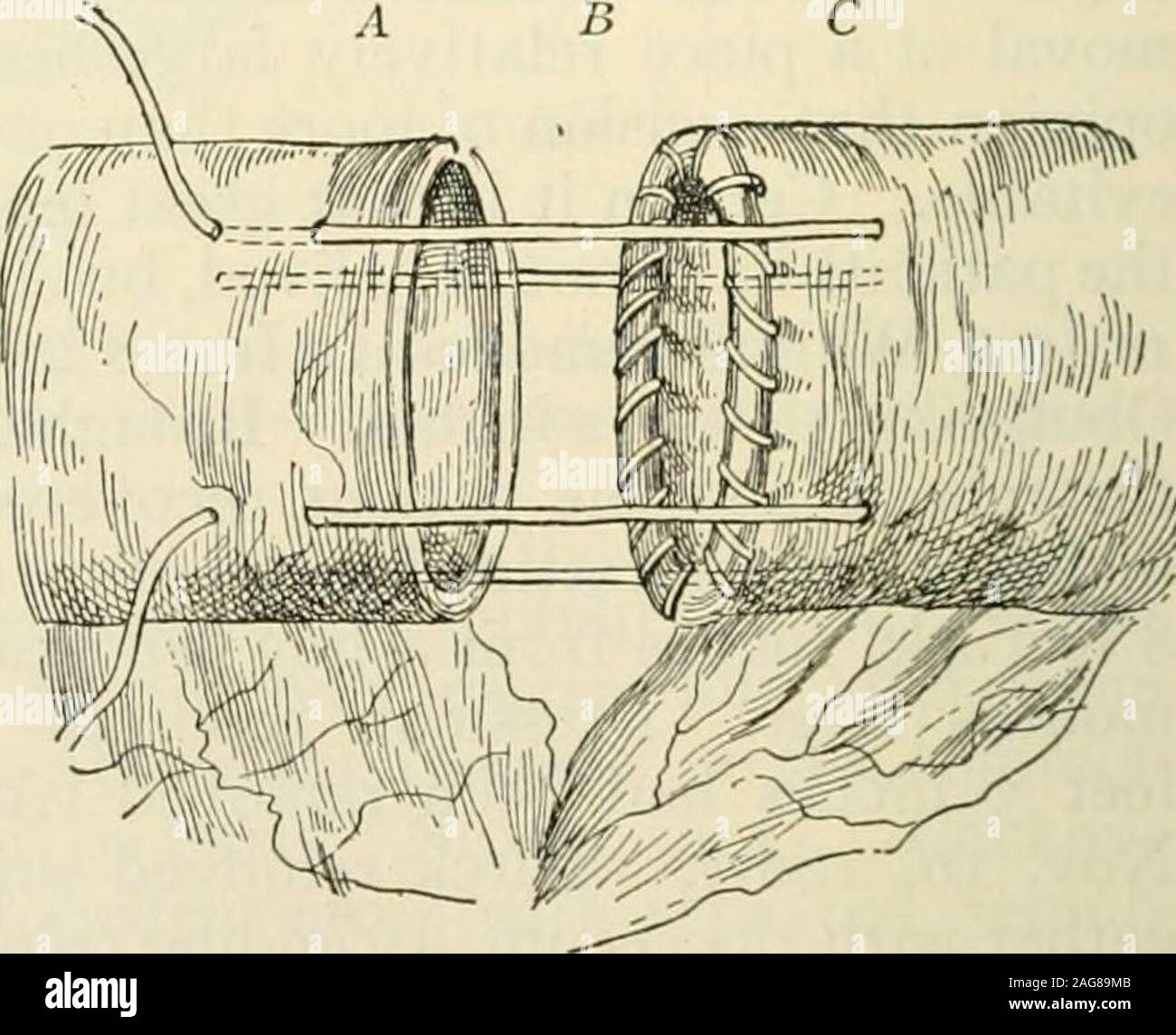 Modern Surgery General And Operative Fig 774 Suture Of The Mesentery Aftercircular Enterorrhaphy Halsted Fig 775 Senns Modification Of Jobertsinvagination Method A Upper End Linedwith Ring B Invagination Sutures In Place C Lower End
