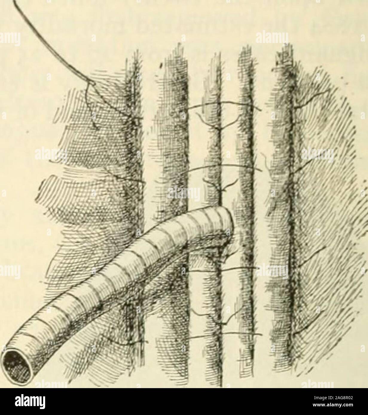 . Modern surgery, general and operative. Fig. 741.—Kaders method of ...