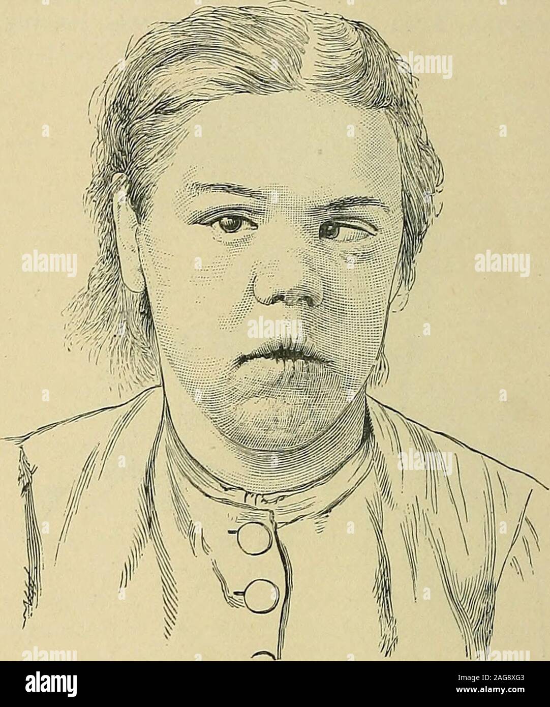 . The diseases of children : medical and surgical. e infant, which was seven weeks old, snuffled a week beforeits death, and three days before a reddish rash appeared on the buttocks and around the G G 450 Syphilis mouth. It was found dead in its cot. At the autopsy the infant was fairly well nourished,there was a purulent discharge issuing from its nose, the skin around the mouth and nosewas excoriated, apparently from the nasal secretion, and there were some excoriations andredness around the anus. The whole of the mucous membrane of the nose was in a foul,almost sloughy condition, the surfa Stock Photo