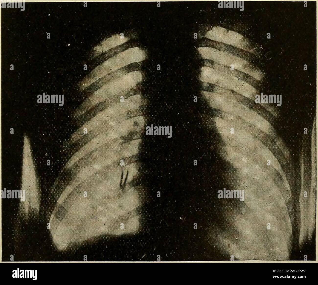 Modern Surgery General And Operative Fig 636 Radiograph Of A Boy Aged Eleven Years Showing Nail That Had Been In Lung Forabout Four Years Producing All The Symptoms Of Bronchiectasis Bronchoscopic Removal